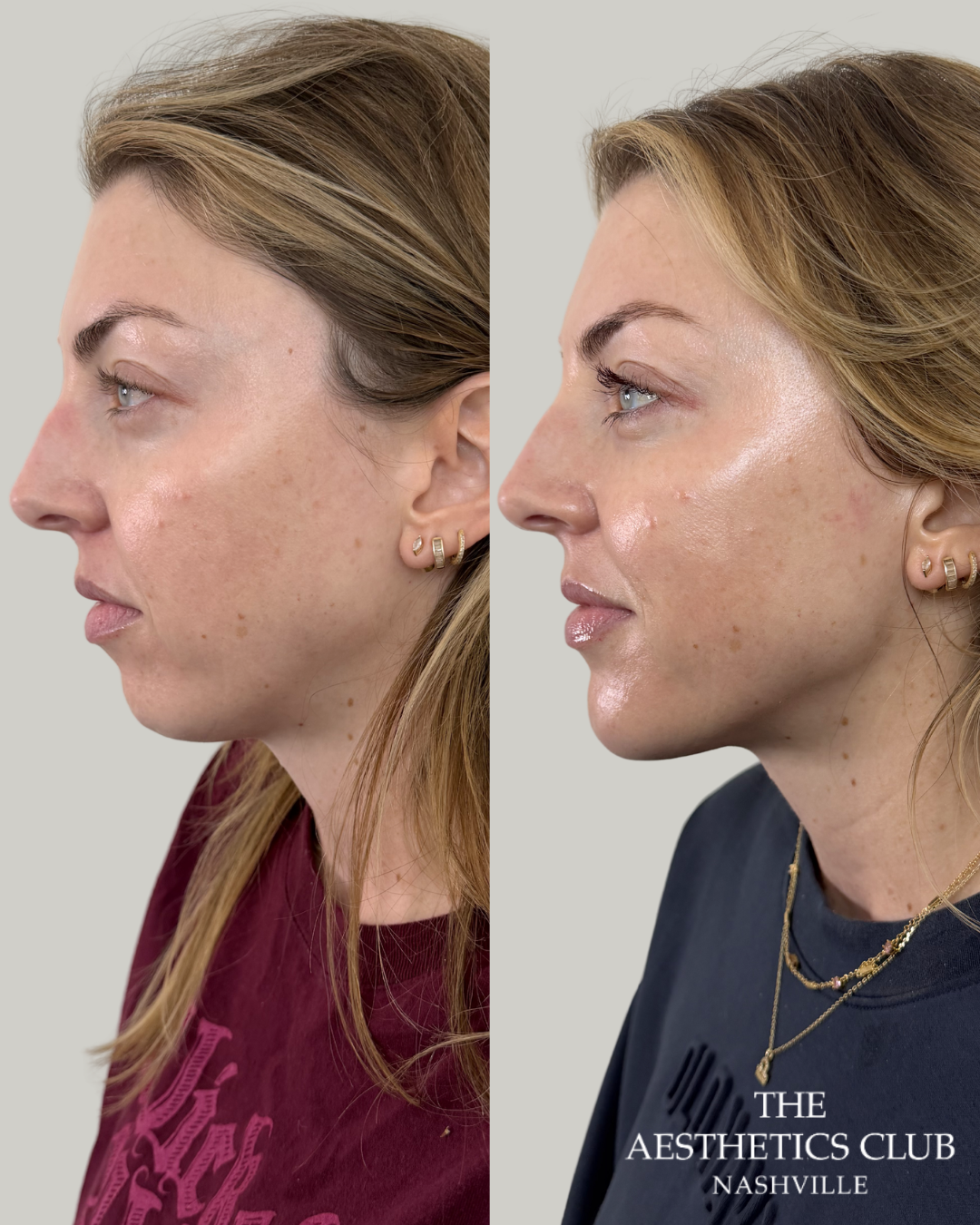 Facial balancing result by Natalie