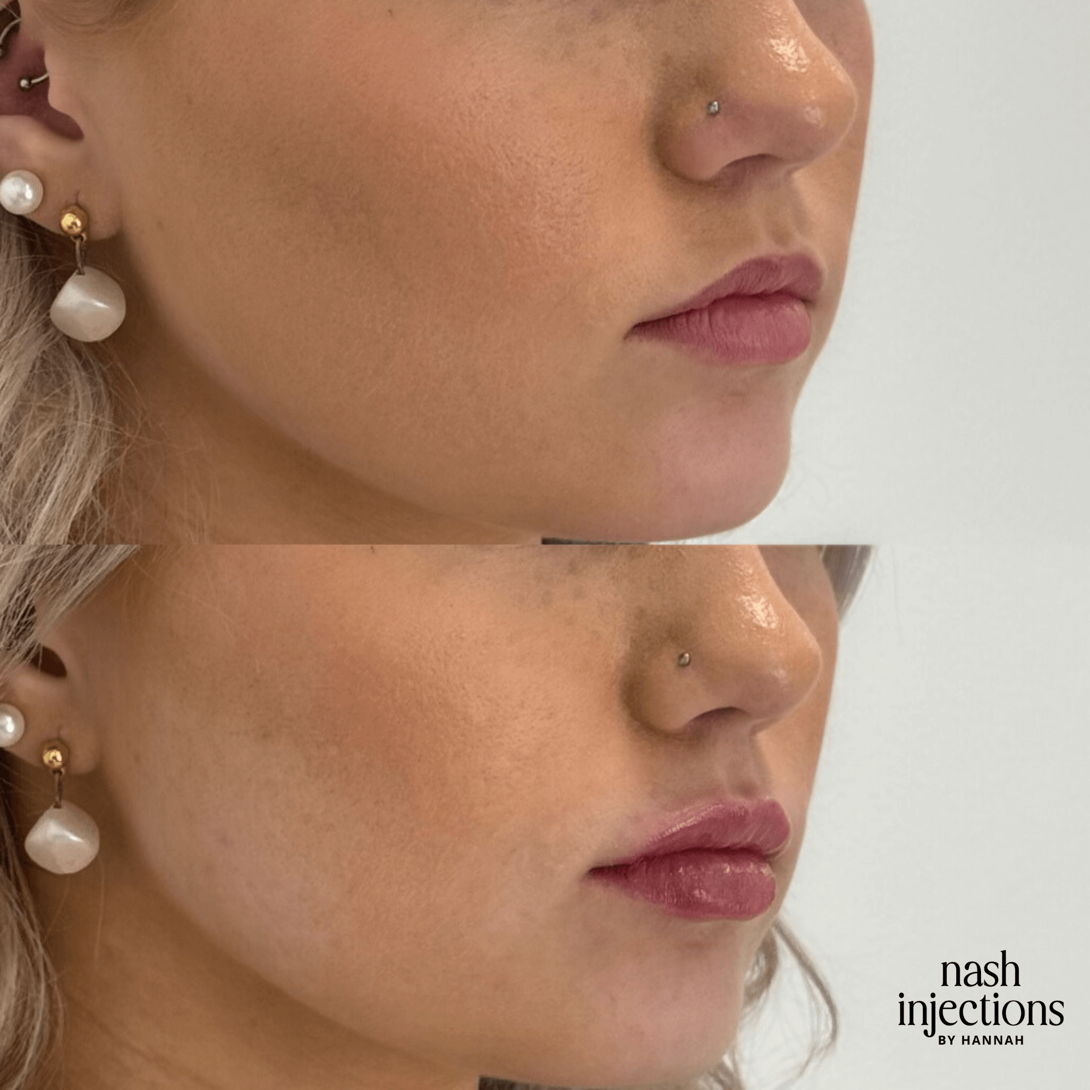 Side-by-side comparison of a woman's lips before and after lip filler treatment, featuring increased lip volume in the after photo; includes earrings and nose piercing.