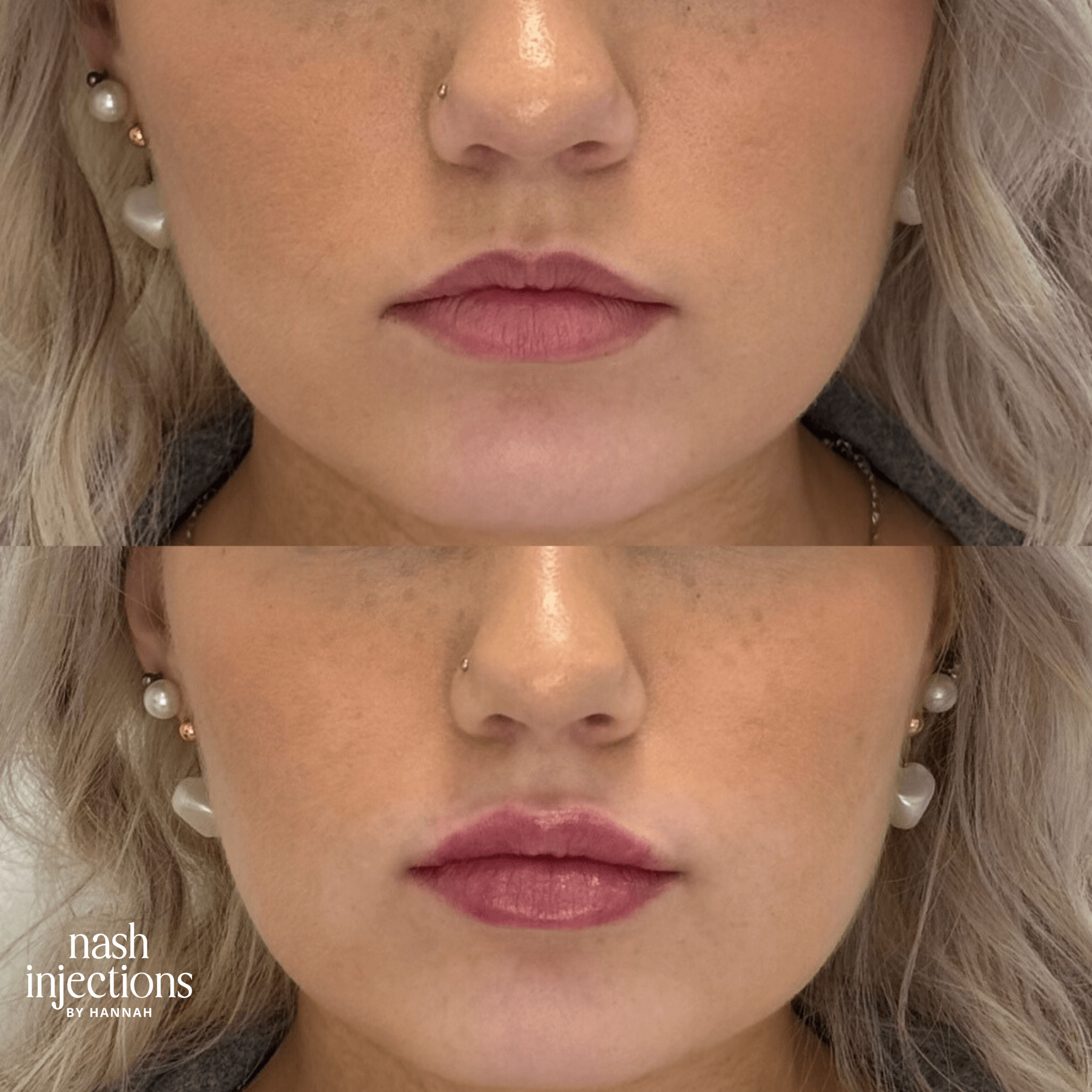 Before and after lip filler treatment showing increased volume and definition.