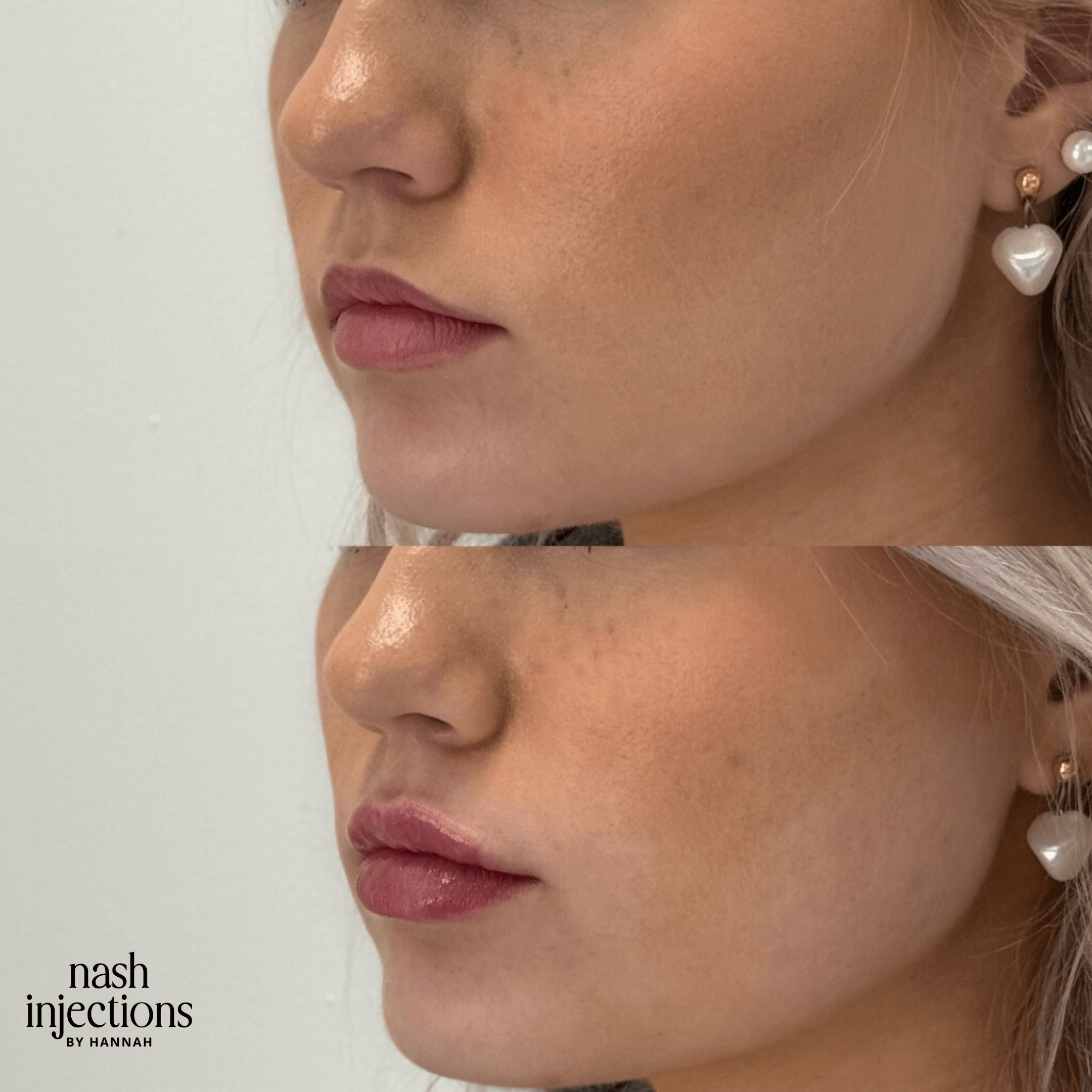 Side-by-side comparison of a woman's lips before and after a cosmetic lip enhancement procedure. The top image shows the lips before enhancement, and the bottom image shows fuller lips after the procedure. The woman is wearing heart-shaped earrings.