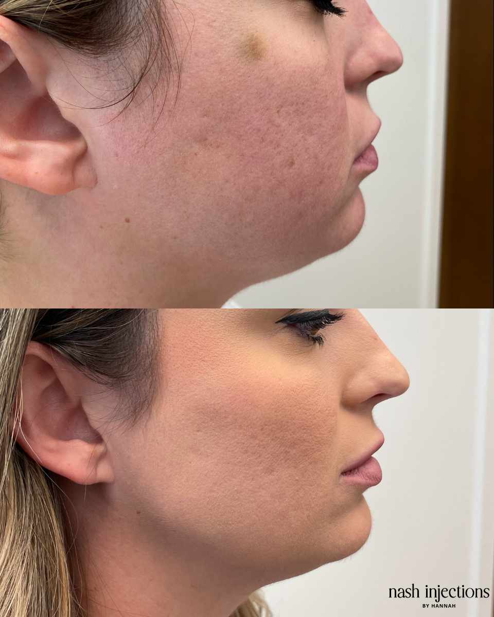 Jawline, Cheek and Chin Filler