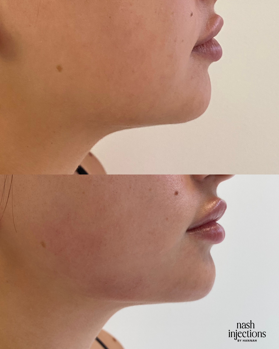 Chin and Jawline Filler