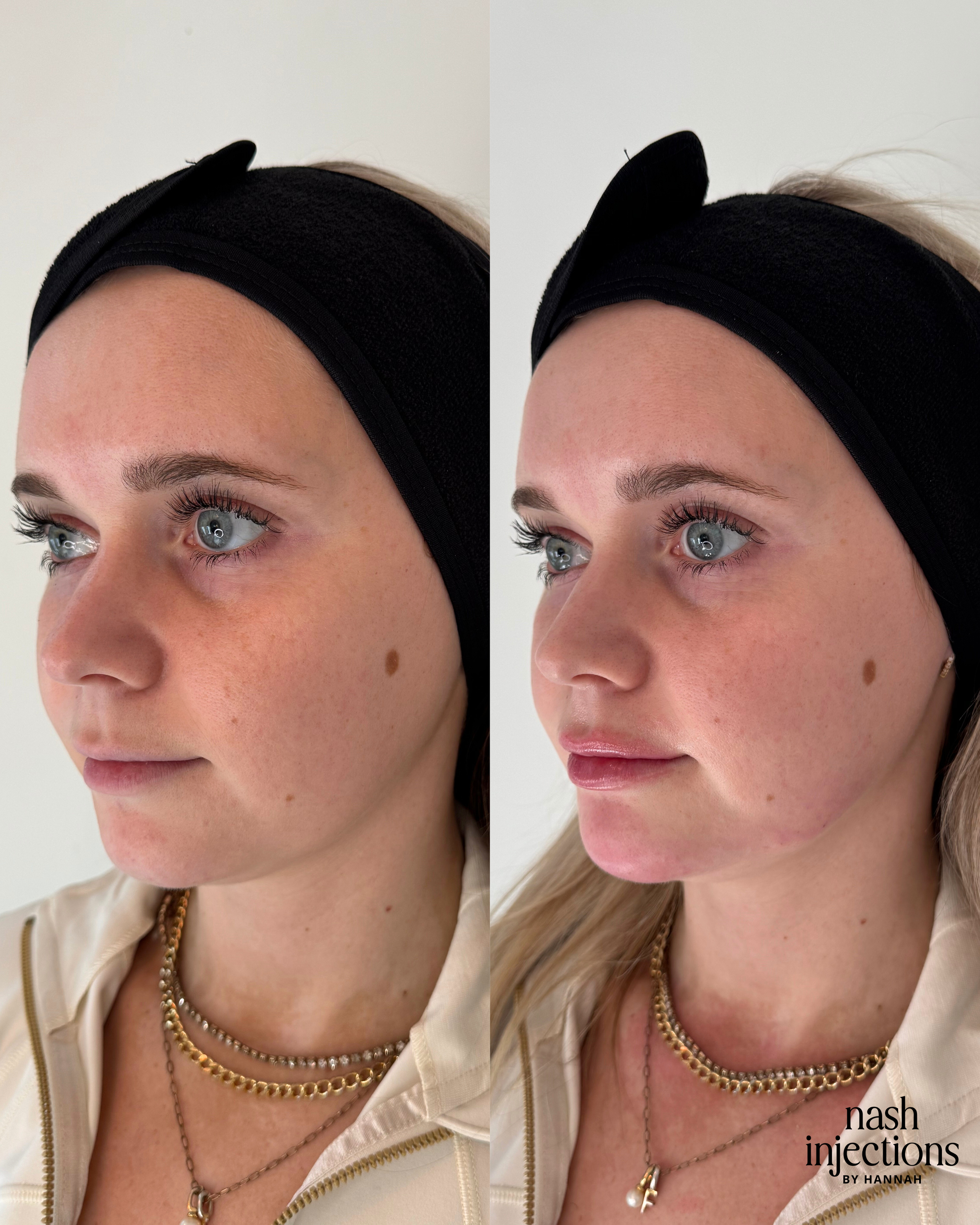 Before and after cosmetic injections showing a woman's facial enhancement.