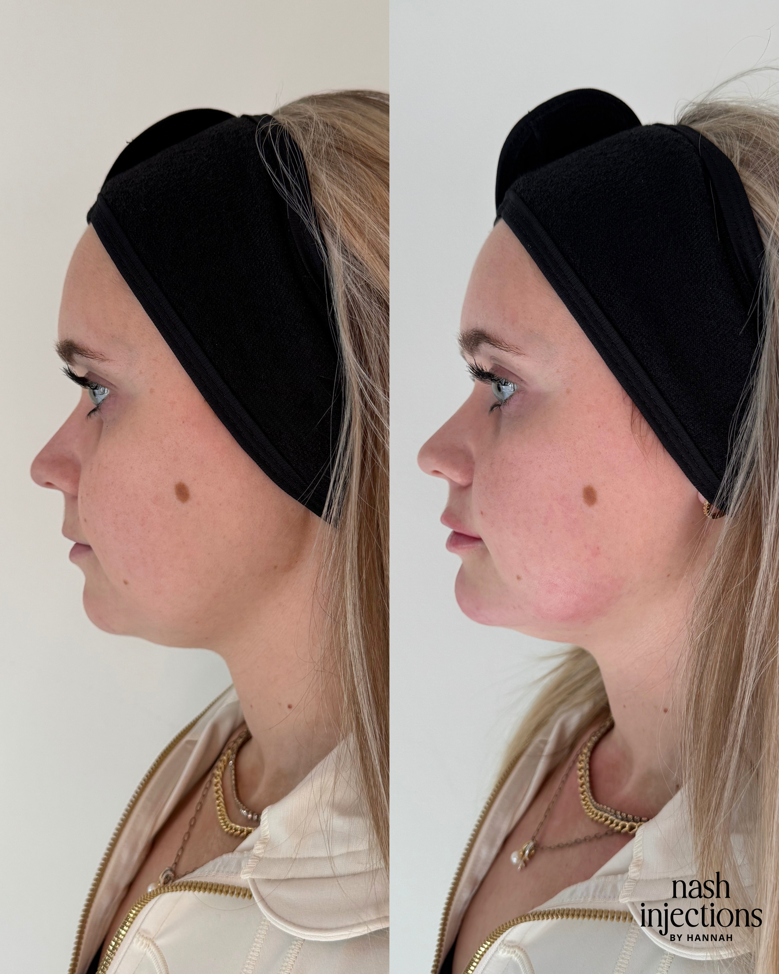 Side-by-side profile comparison of a person's face before and after a cosmetic procedure. The individual is wearing a black headband and has a noticeable change in the jawline contour. Text "nash injections by Hannah" is visible in the bottom right corner.