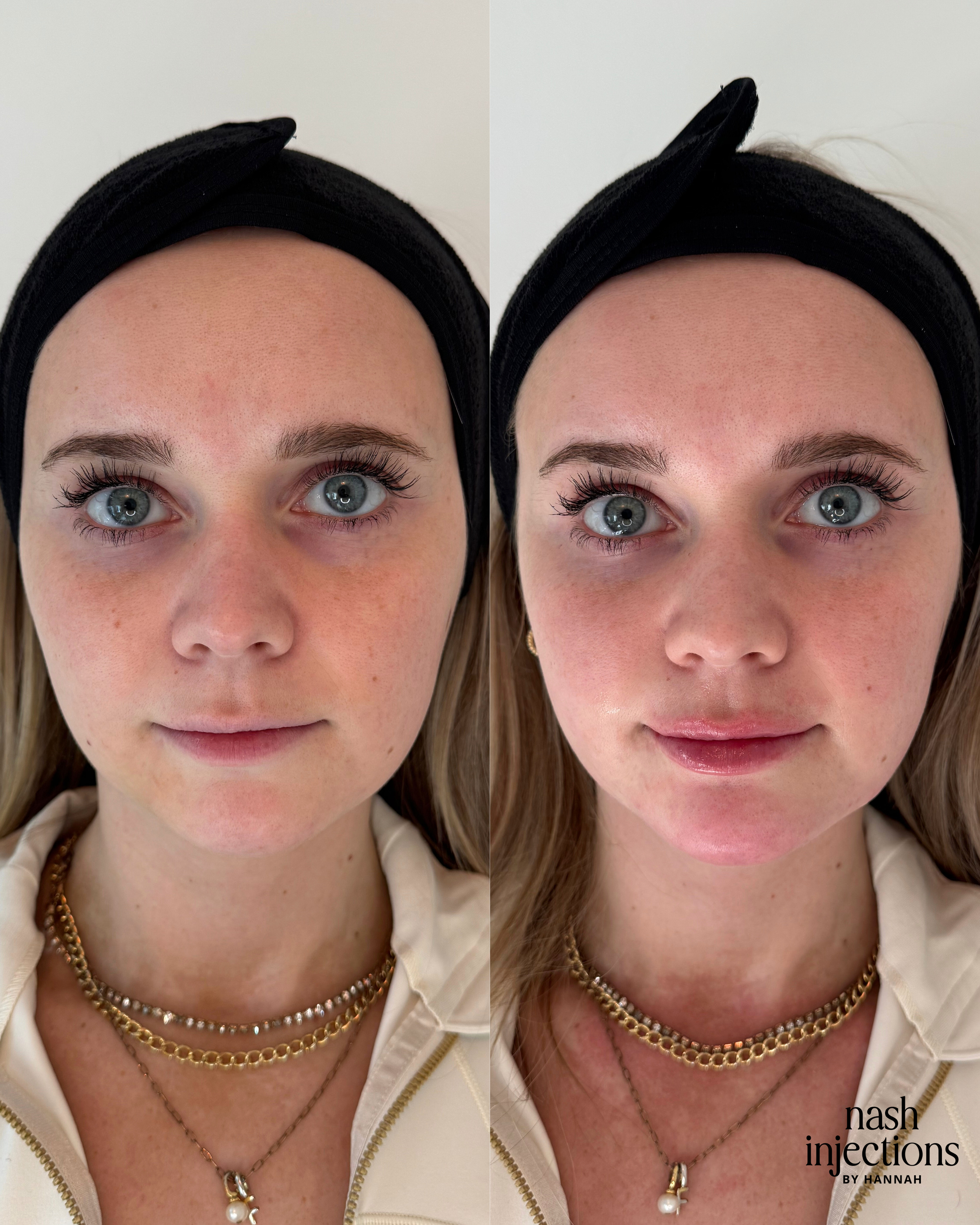 Before and after images of a woman's face regarding cosmetic treatment, wearing a black headband and gold necklaces.