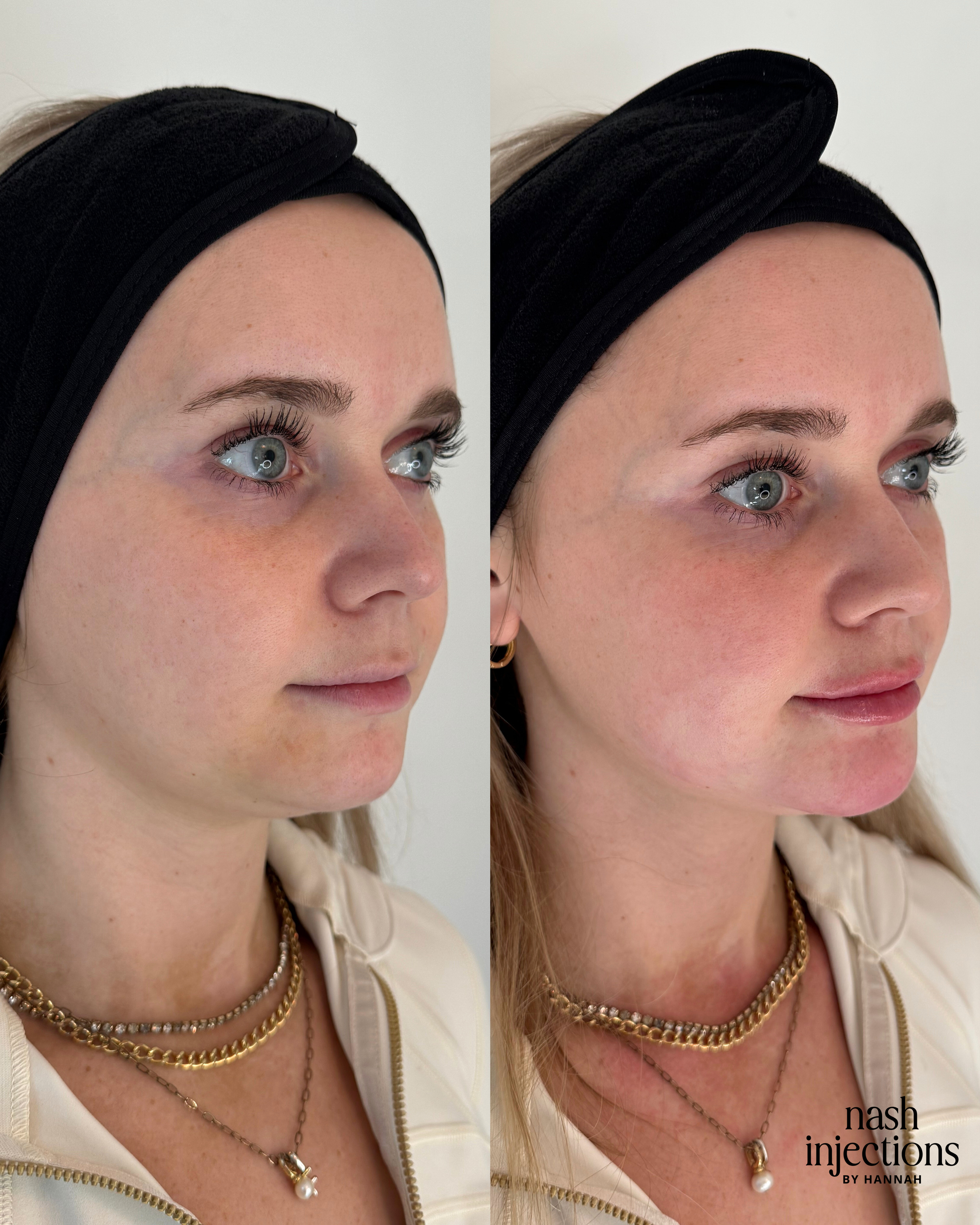 Side-by-side comparison of a woman's face with and without cosmetic injections, wearing a black headband and necklaces. Her skin appears more even and smooth on the right.