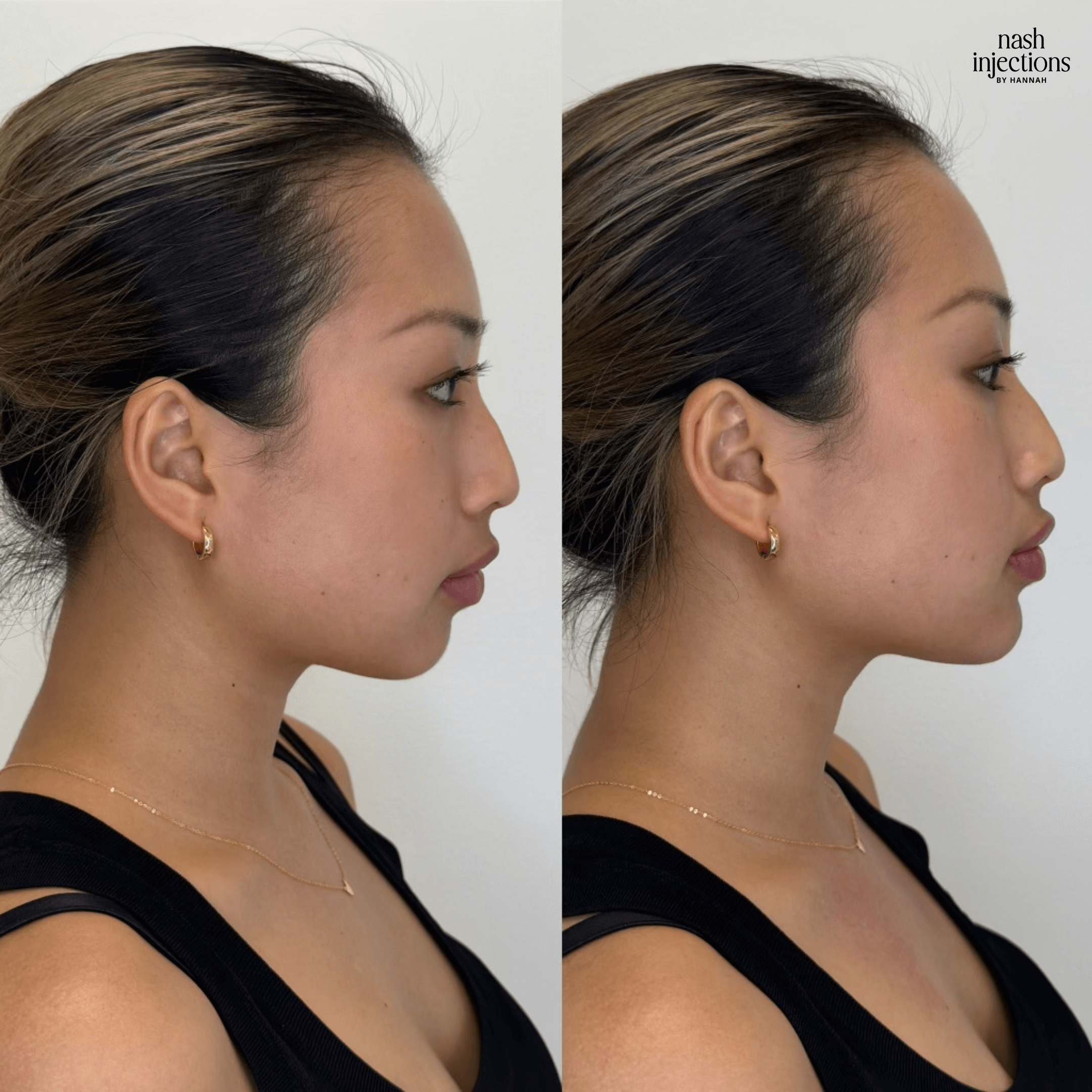 Side-by-side images of a woman's profile showing before and after results of a cosmetic procedure, focusing on the jawline and neckline. The woman has her hair tied back and is wearing hoop earrings and a black top, with a light background.