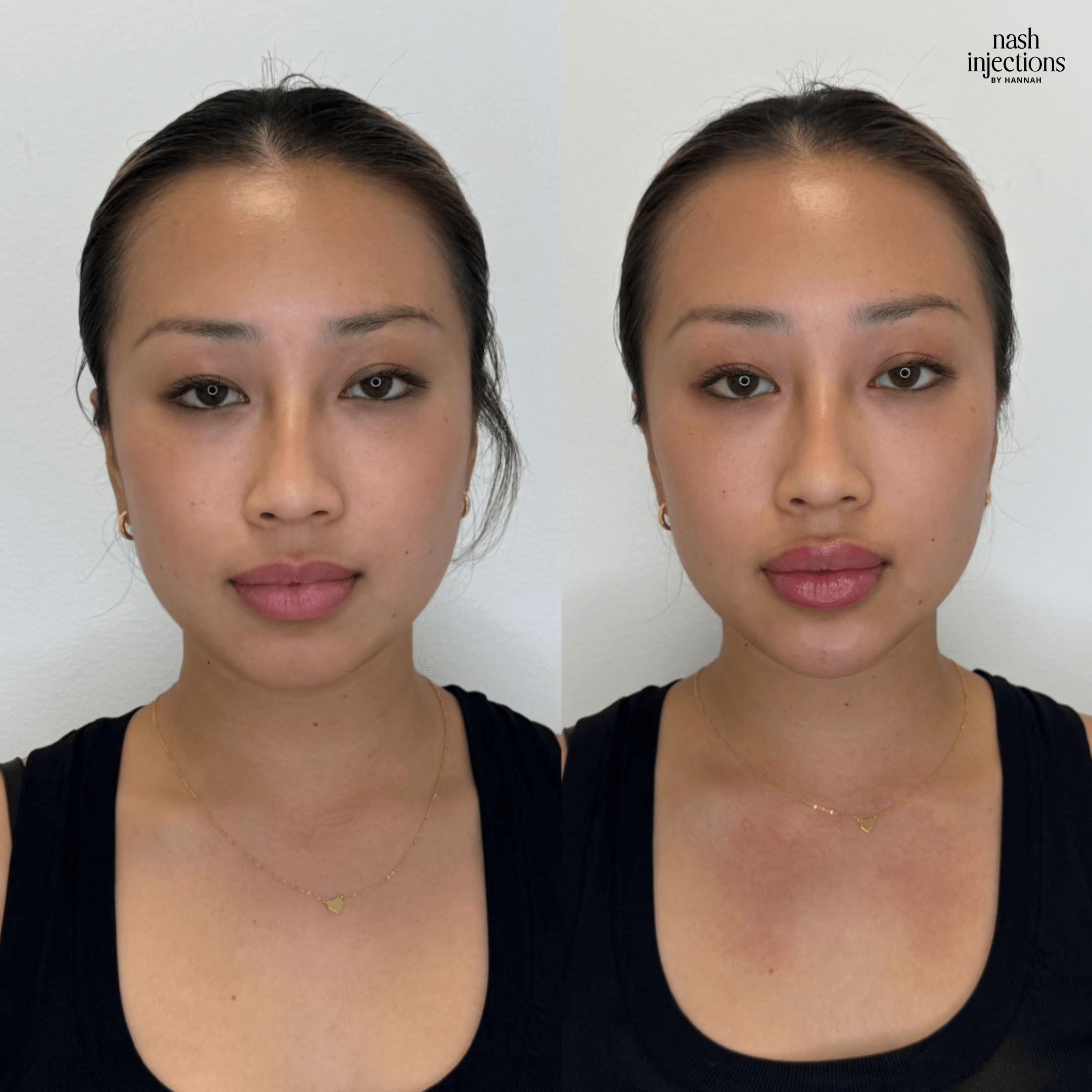 Before and after comparison of a woman showing facial changes, possibly due to cosmetic procedures, wearing a black top and necklace.