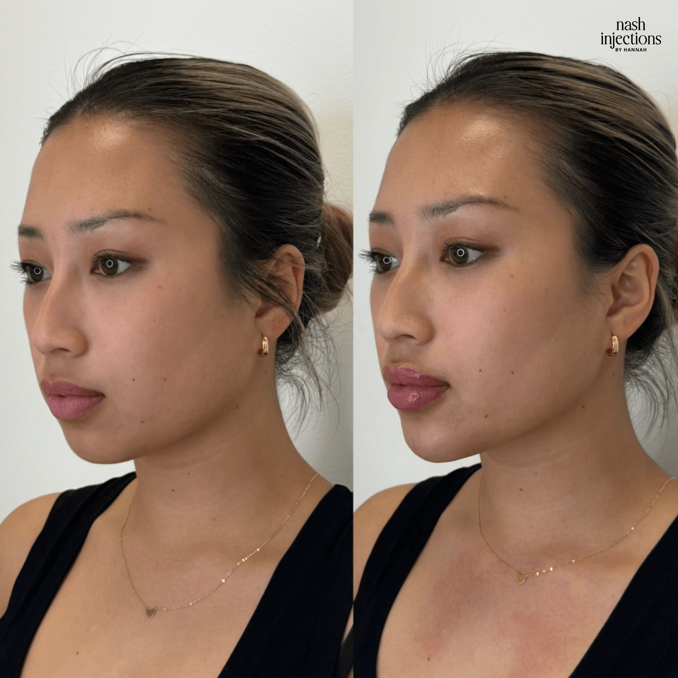 Side-by-side before and after images of a woman showing facial enhancement results. The woman has her hair tied back, wears a black top, and earrings. The images illustrate changes in facial appearance, possibly from cosmetic injections.