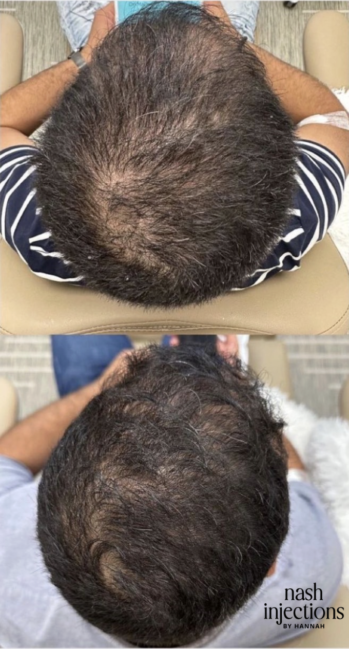 Comparison of a man before and after hair injection treatment, showing increased hair density