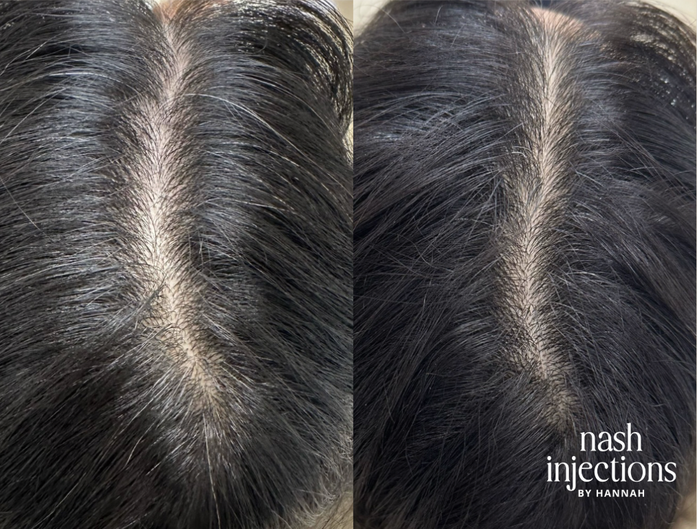 Side-by-side comparison of a person's scalp showing hair before and after a treatment, with the right side labeled 'Nash Injections by Hannah'.