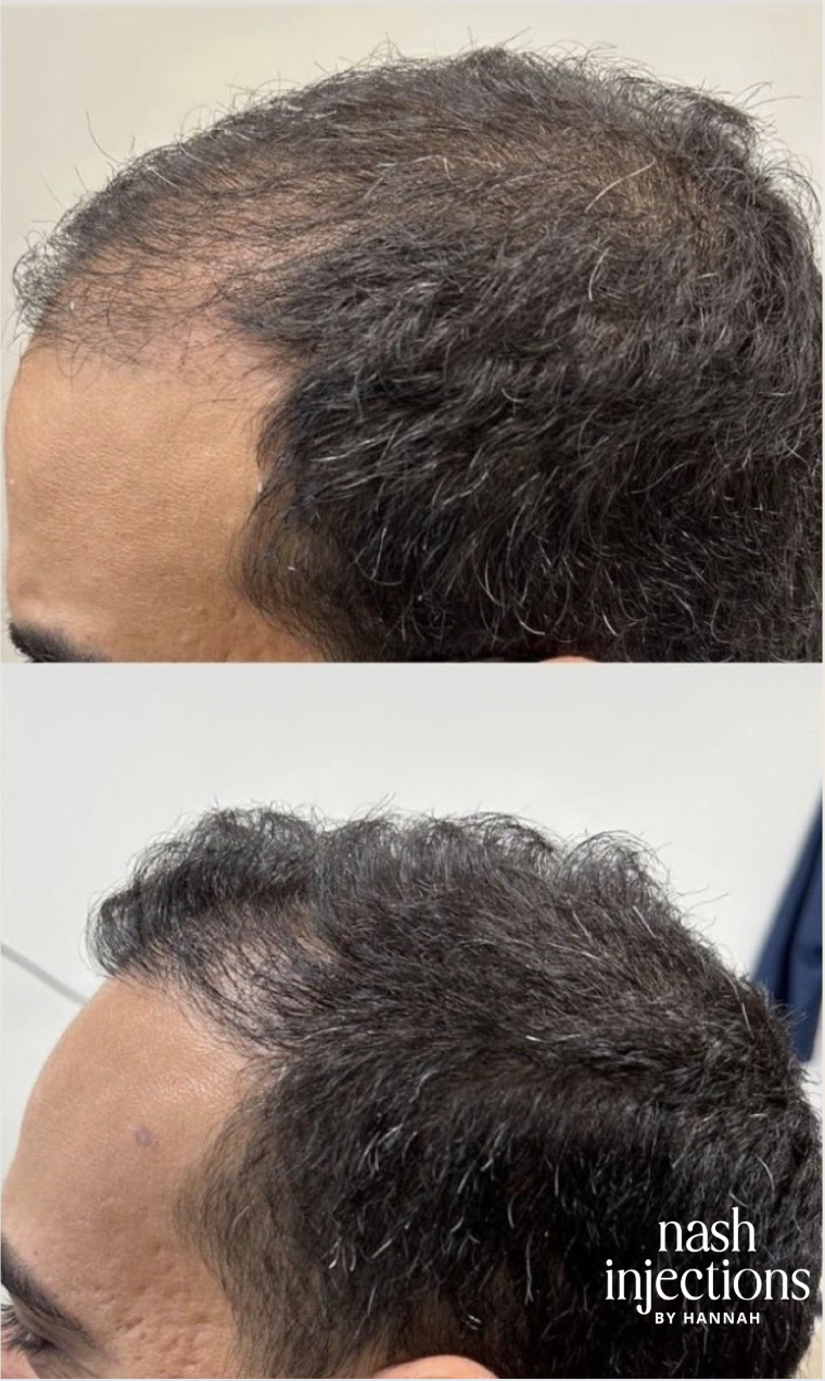 Comparison of a man's scalp before and after hair restoration treatment showing improved hair density.