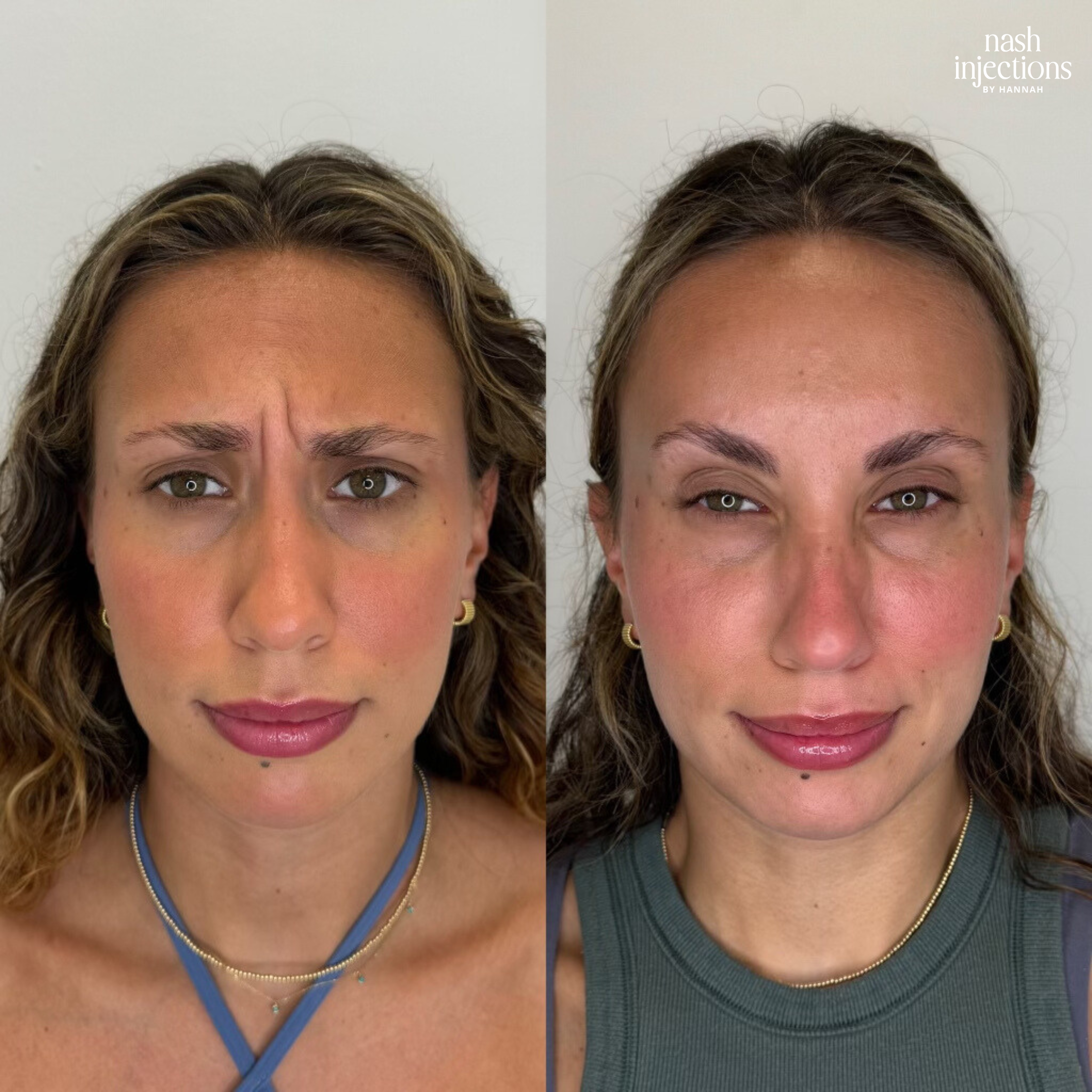 Botox for Frown Lines