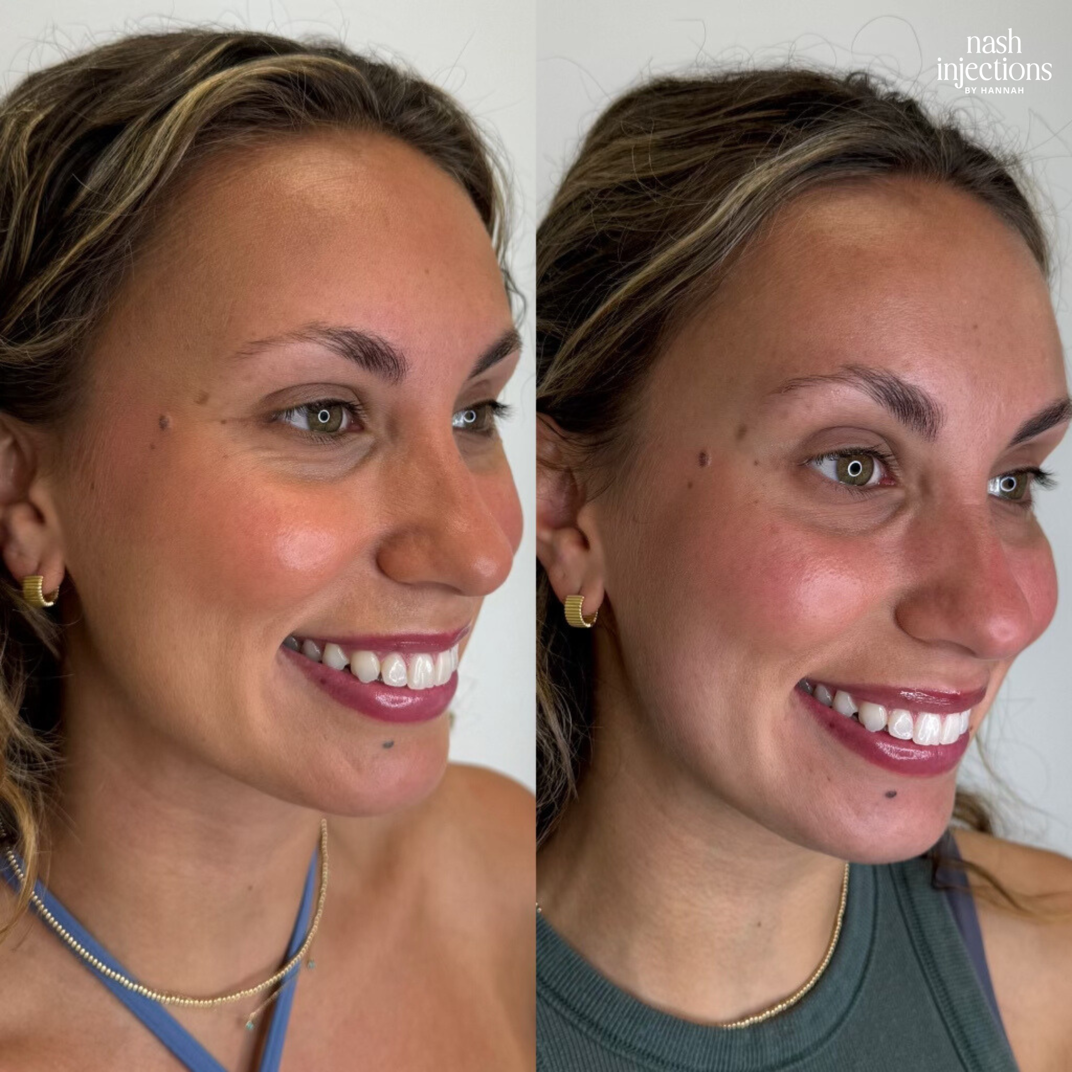 Botox for Crow's feet