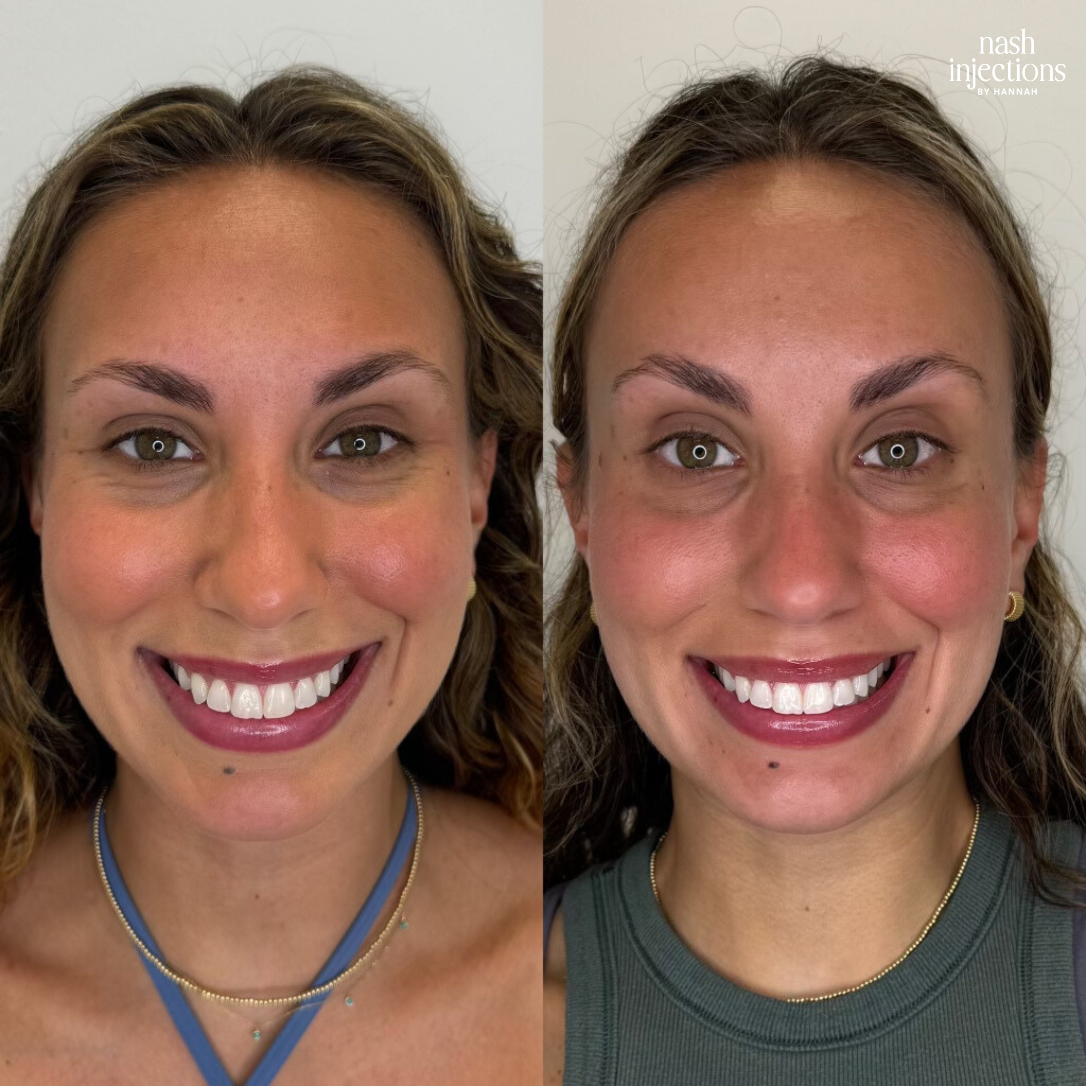 Botox for Brow Lift