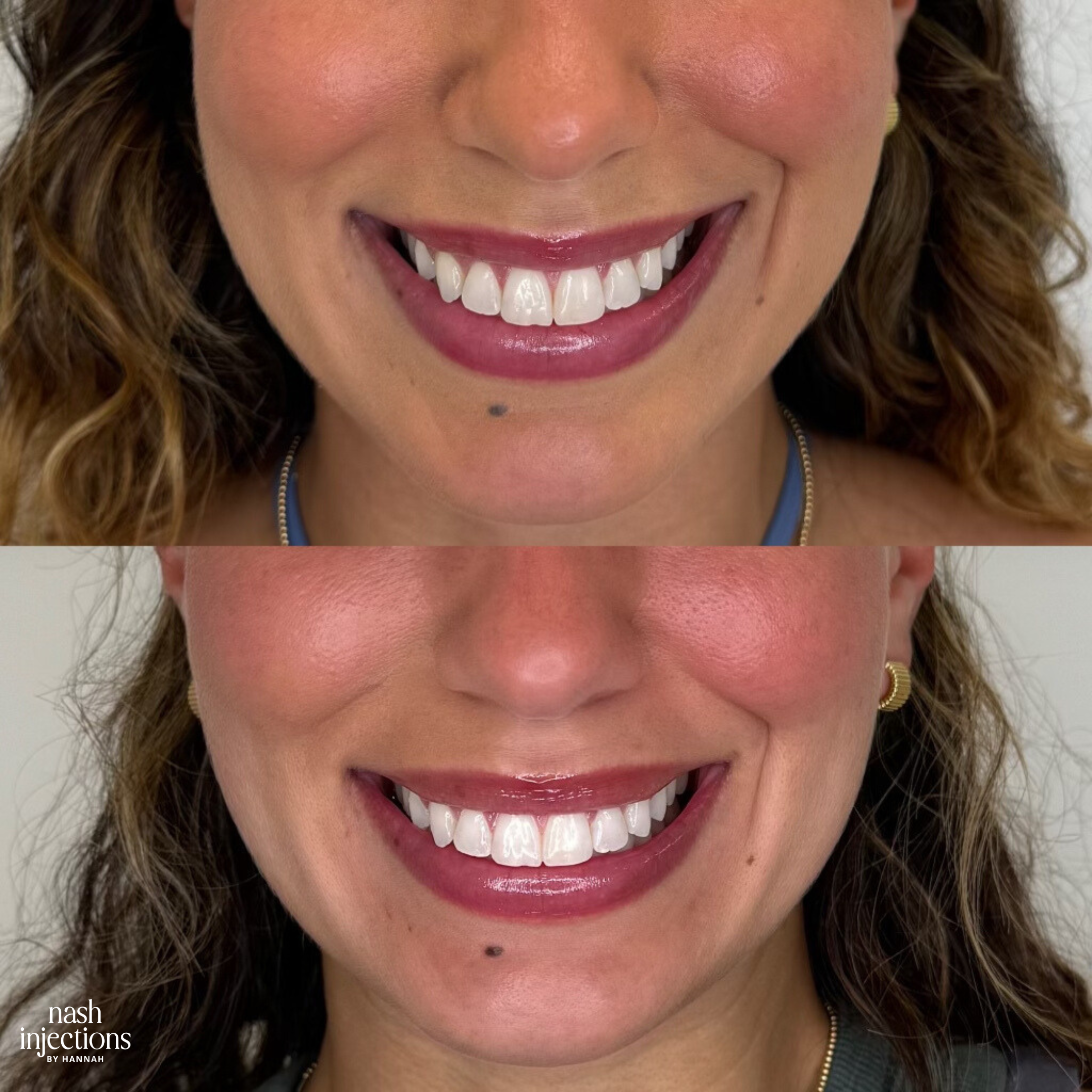 Botox Lip Flip