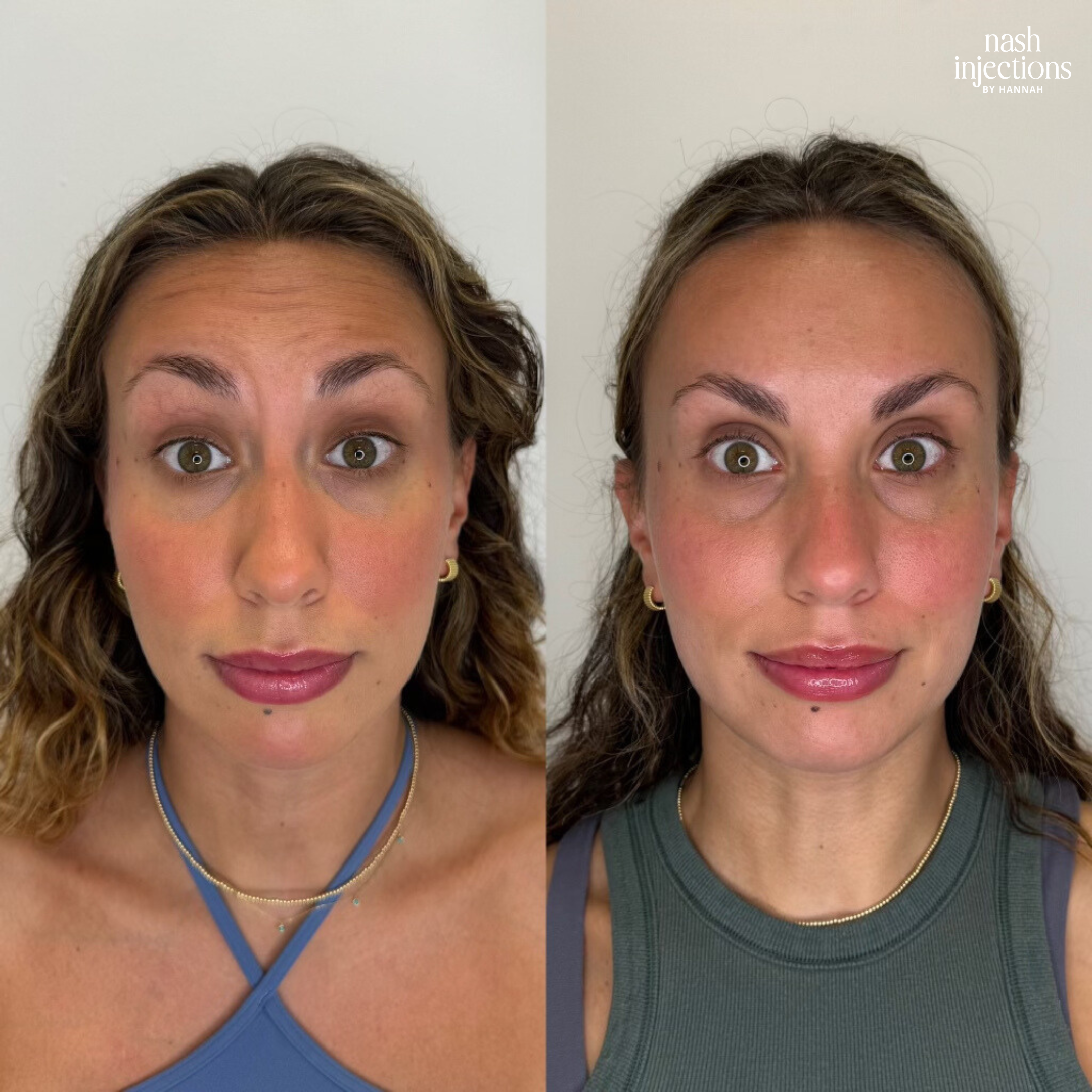 Botox for Forehead Lines