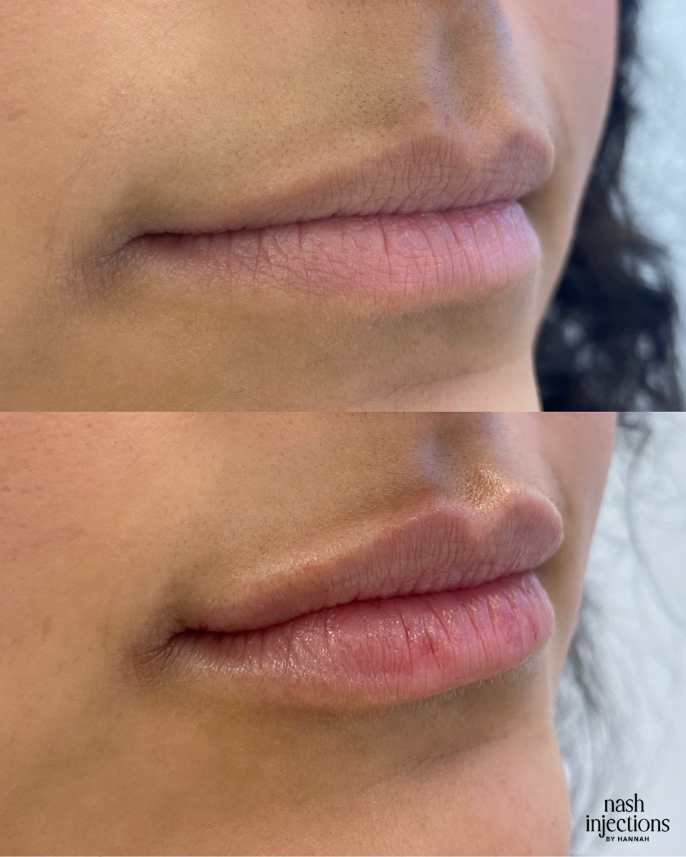 Natural Lip Filler