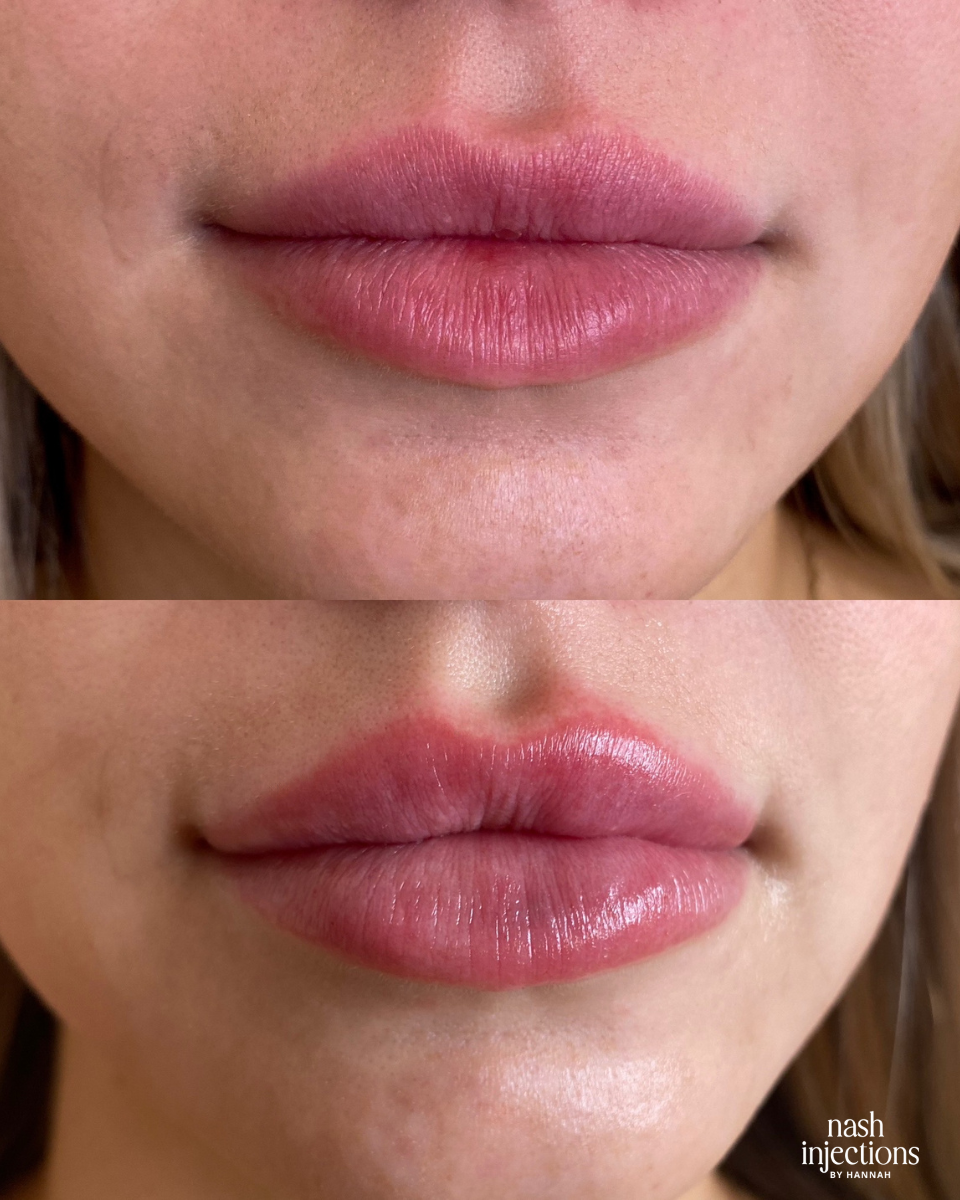 Plump lips with filler
