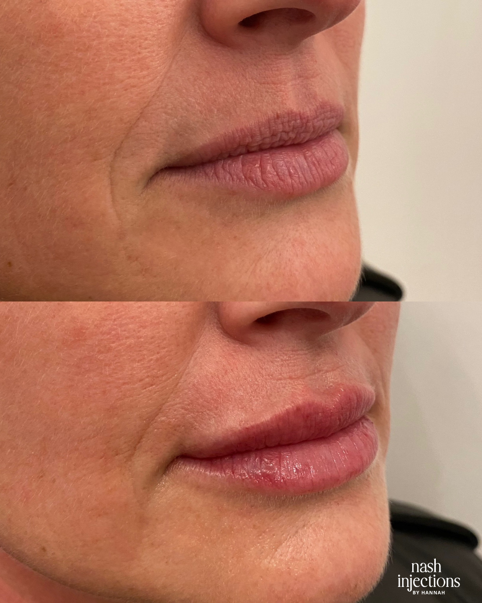 Woman with lip fillers