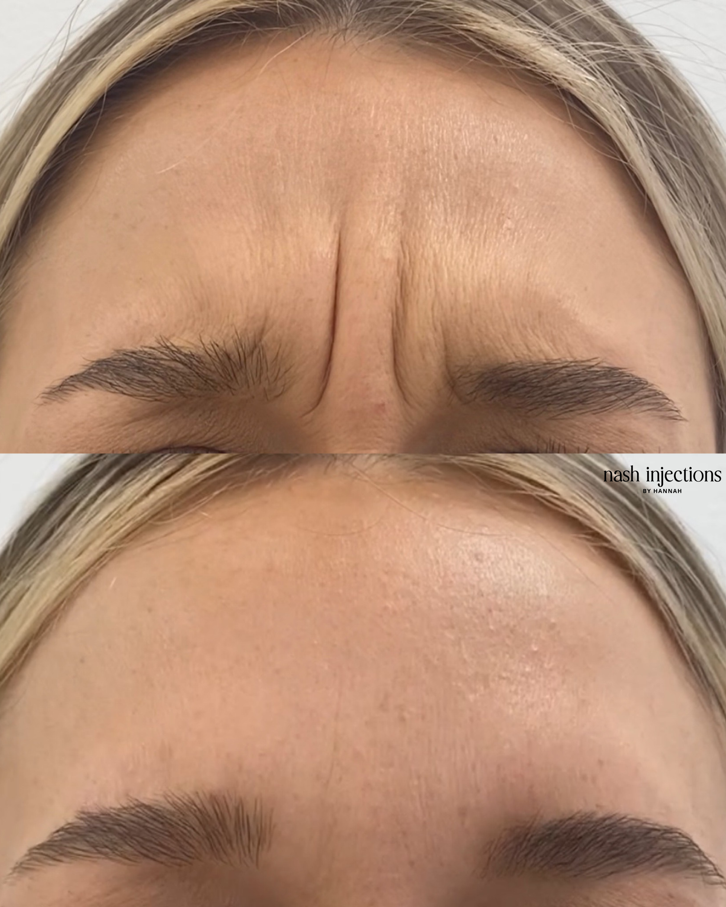 Woman with Botox for fine lines and wrinkles