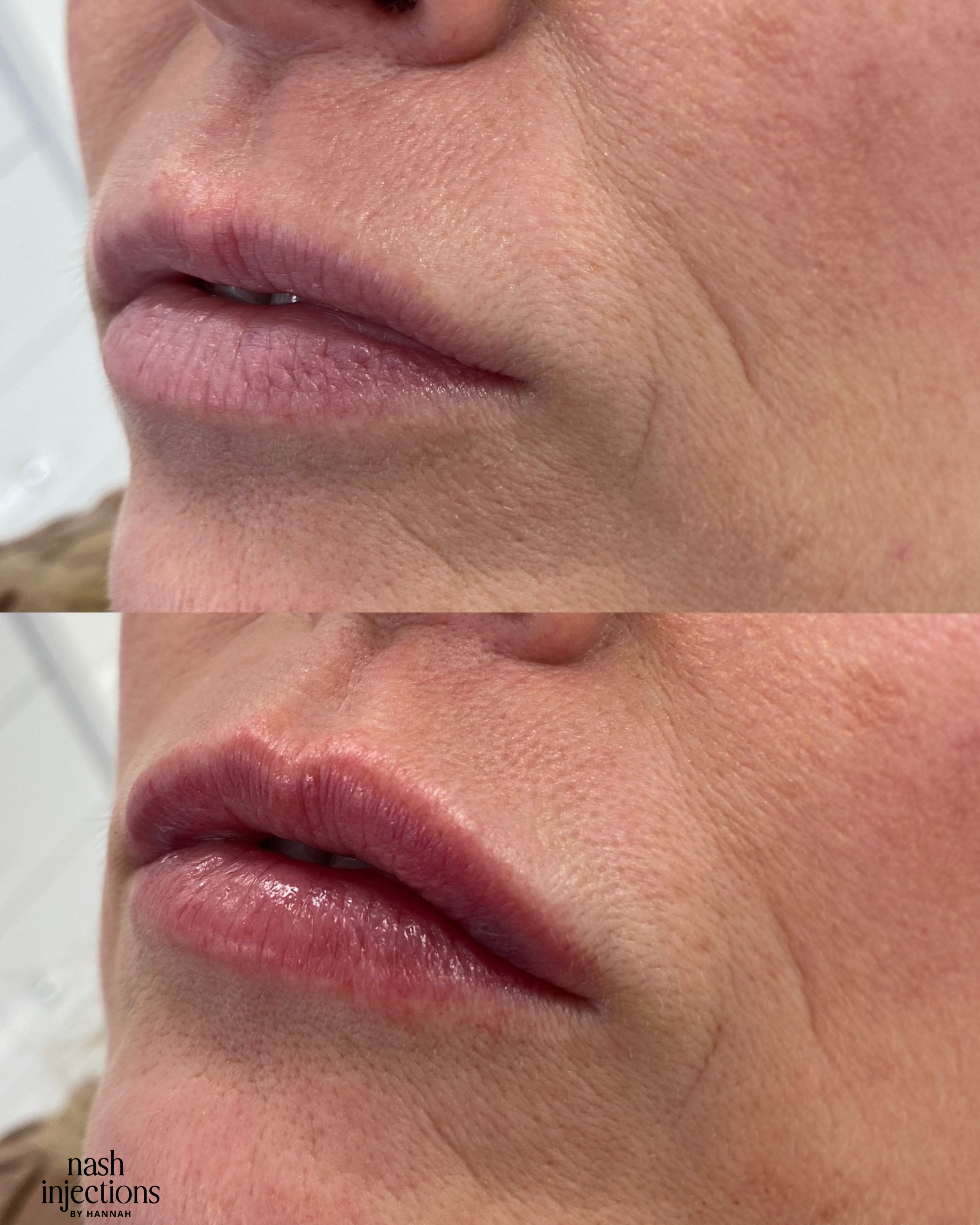 Woman with natural lip filler