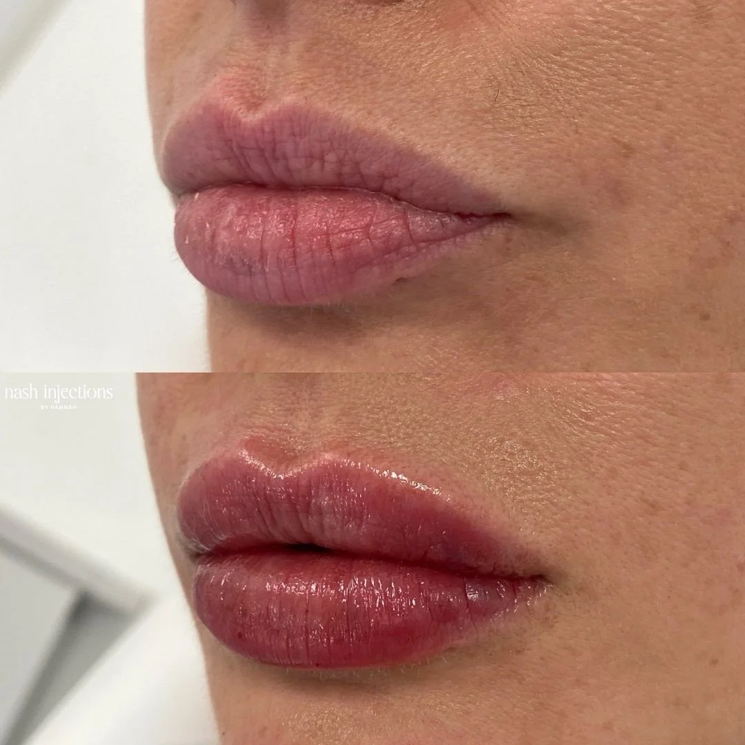 Lip Filler Before and After
