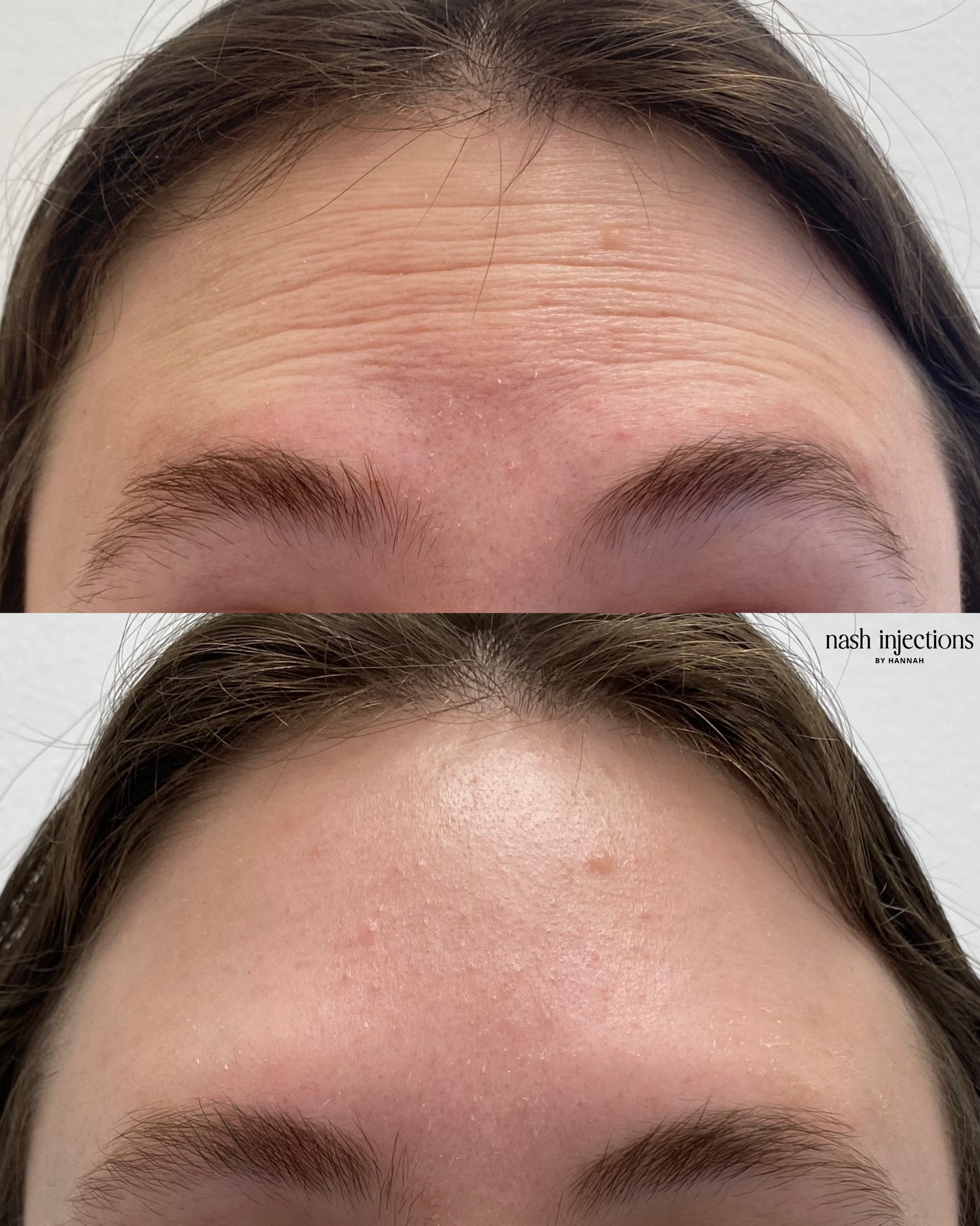 Before and after Botox