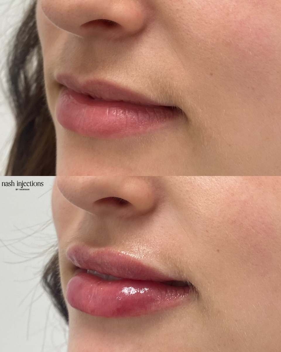 Lip fillers before and after