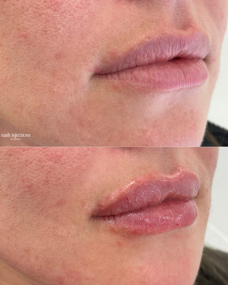 Lip Filler RHA 2
