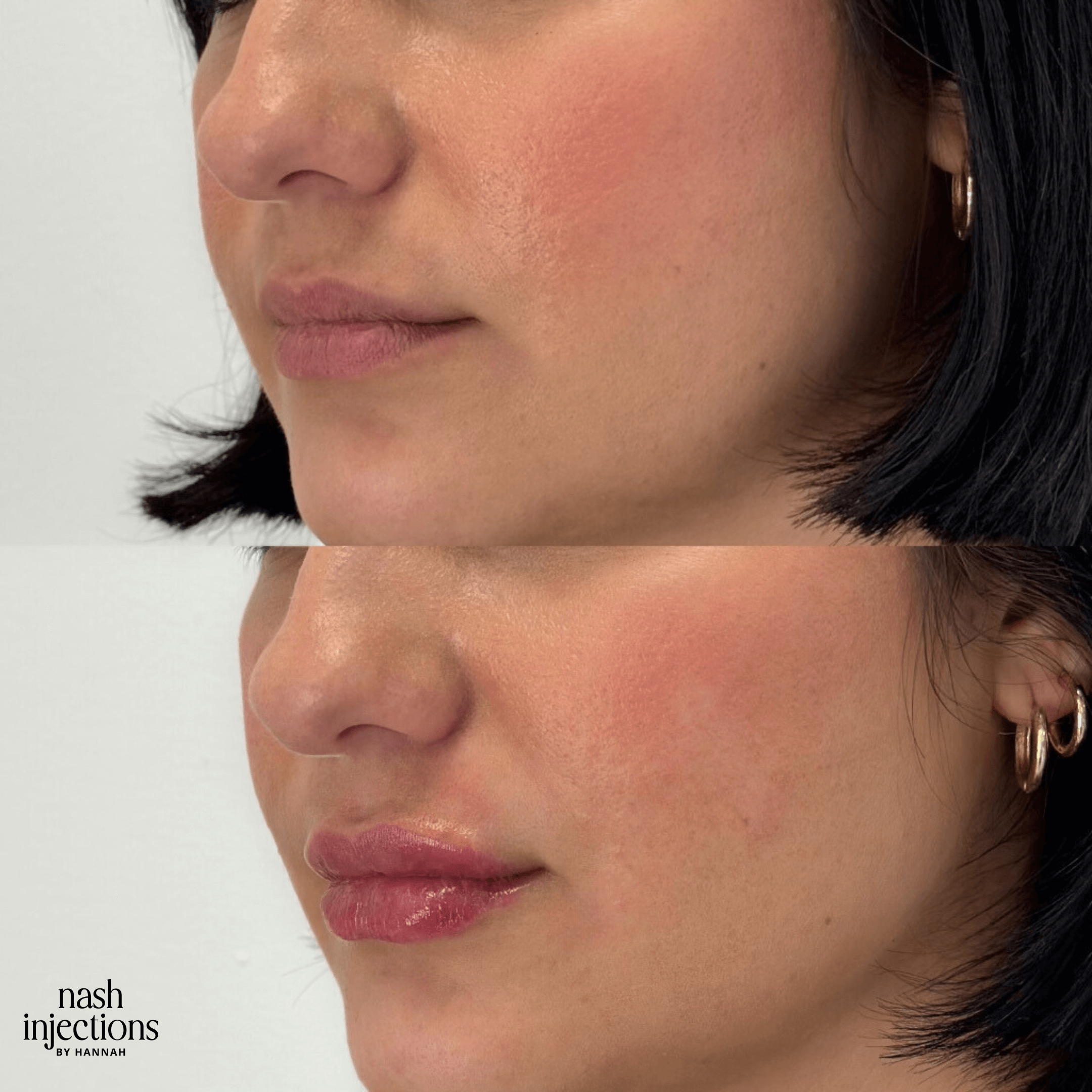Before and after comparison of lip enhancement procedure.