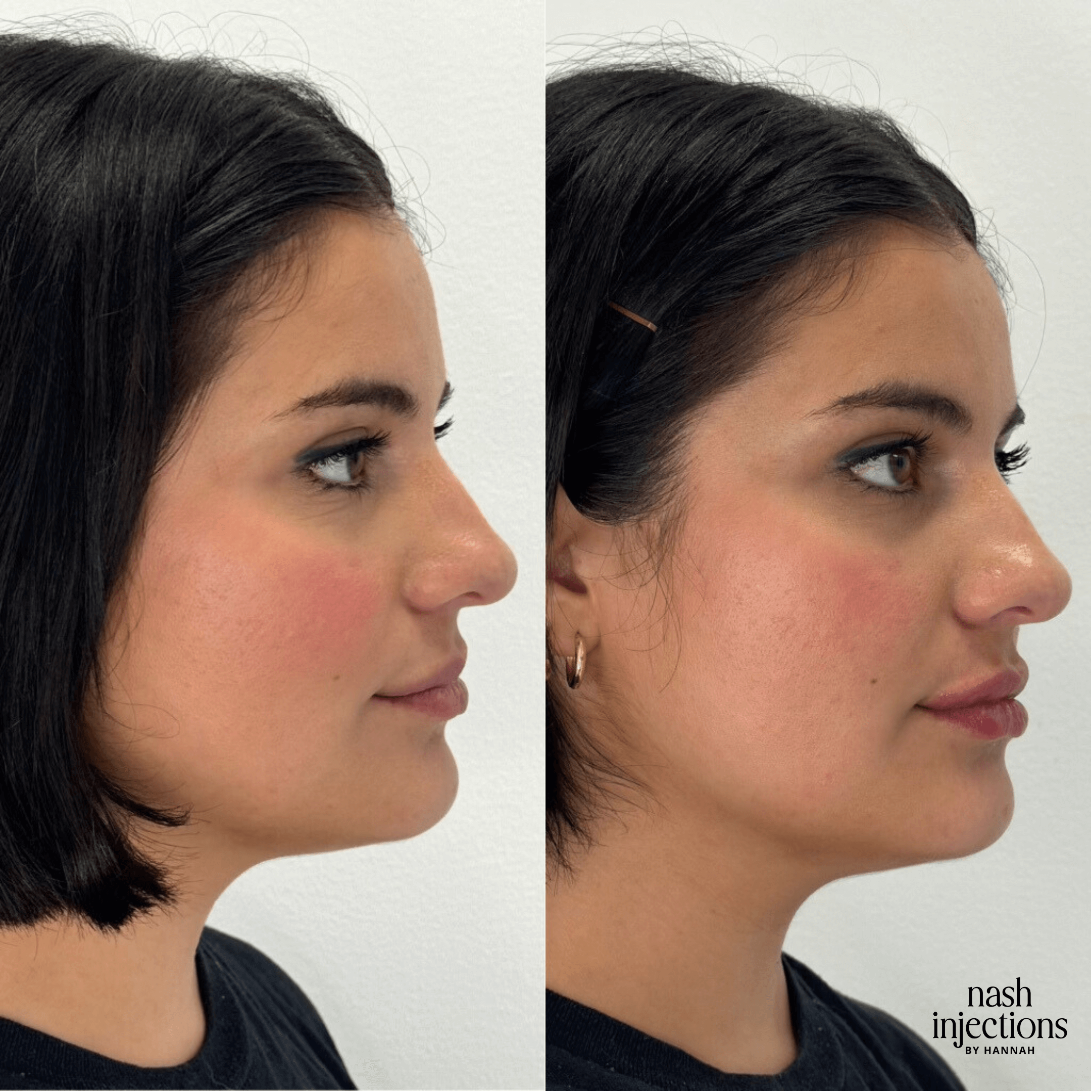 Before and after side profile comparison of a woman's face showcasing subtle cosmetic changes.