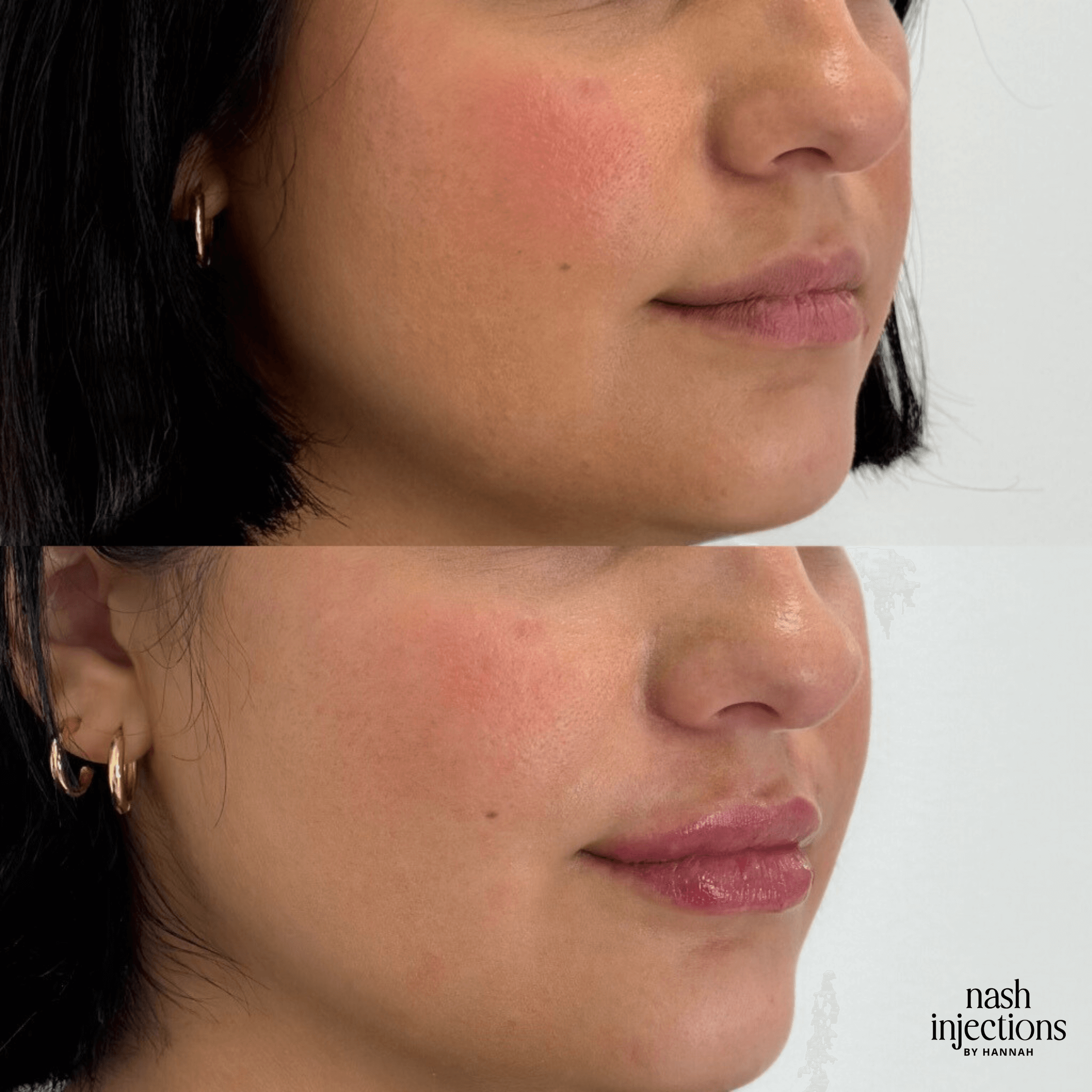 Side-by-side before and after images showing a person's face with lip enhancements.