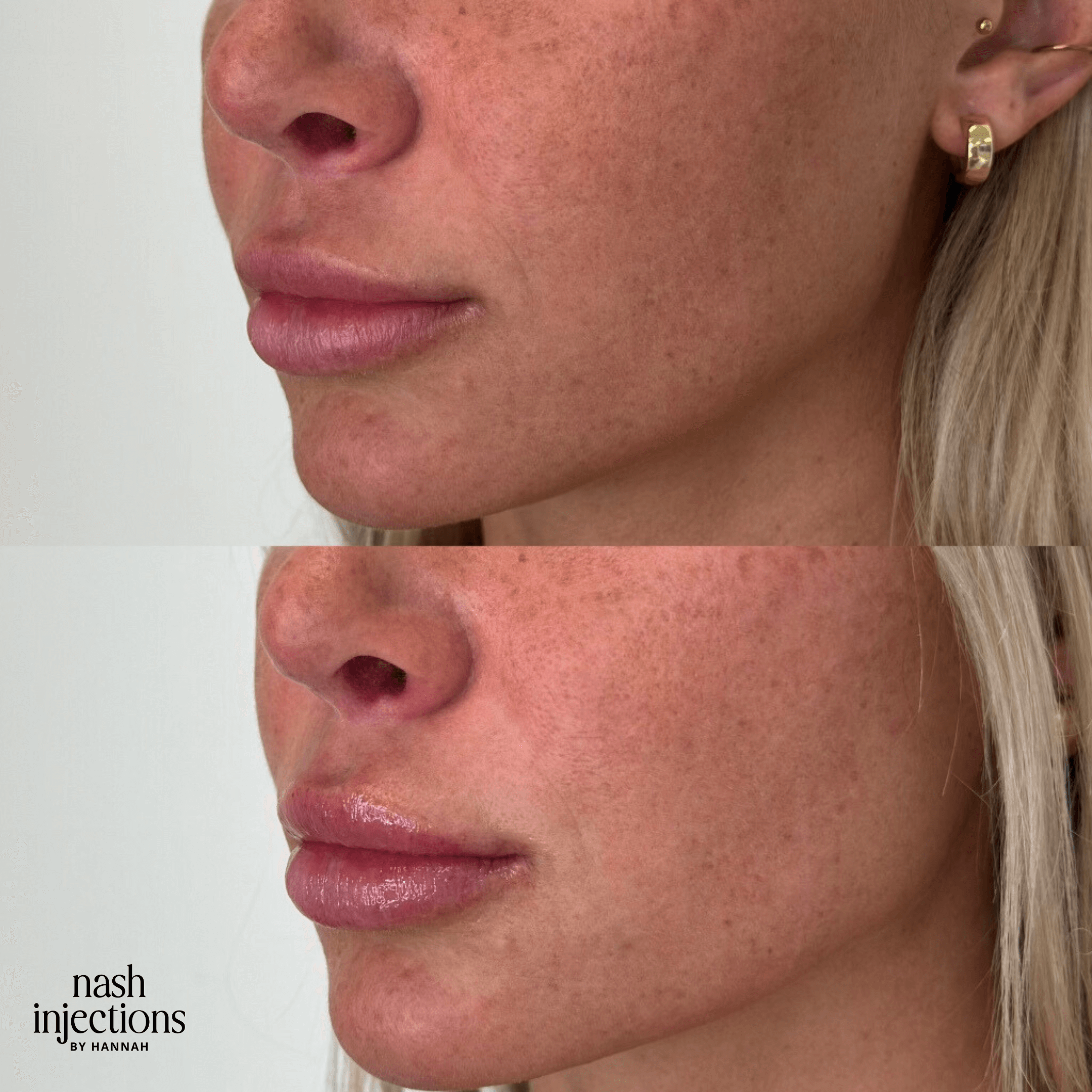Before and after lip enhancement comparison, showing close-up side view of a person's lips and lower face.