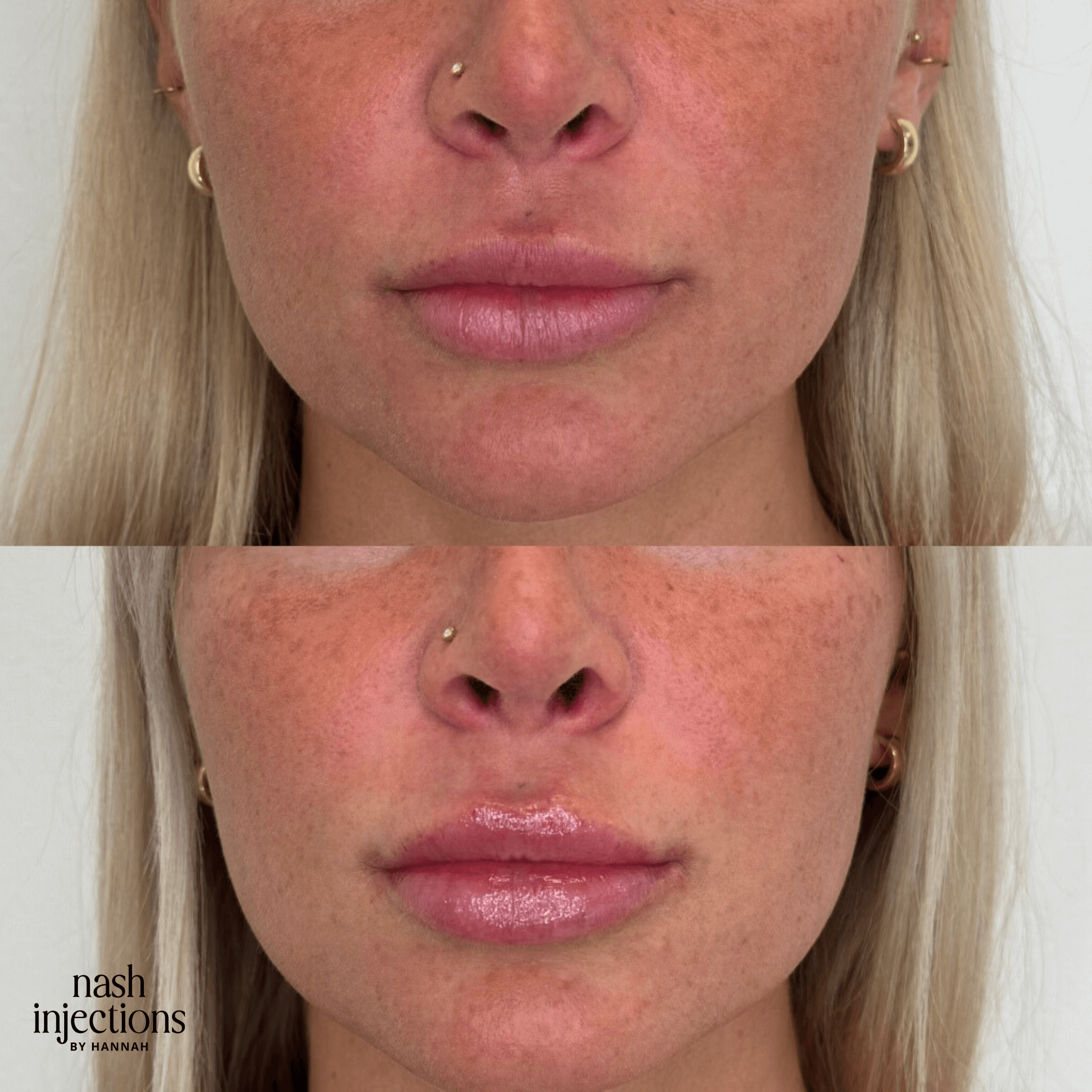 Before and after images of a person showing lip enhancement with increased fullness and glossiness.