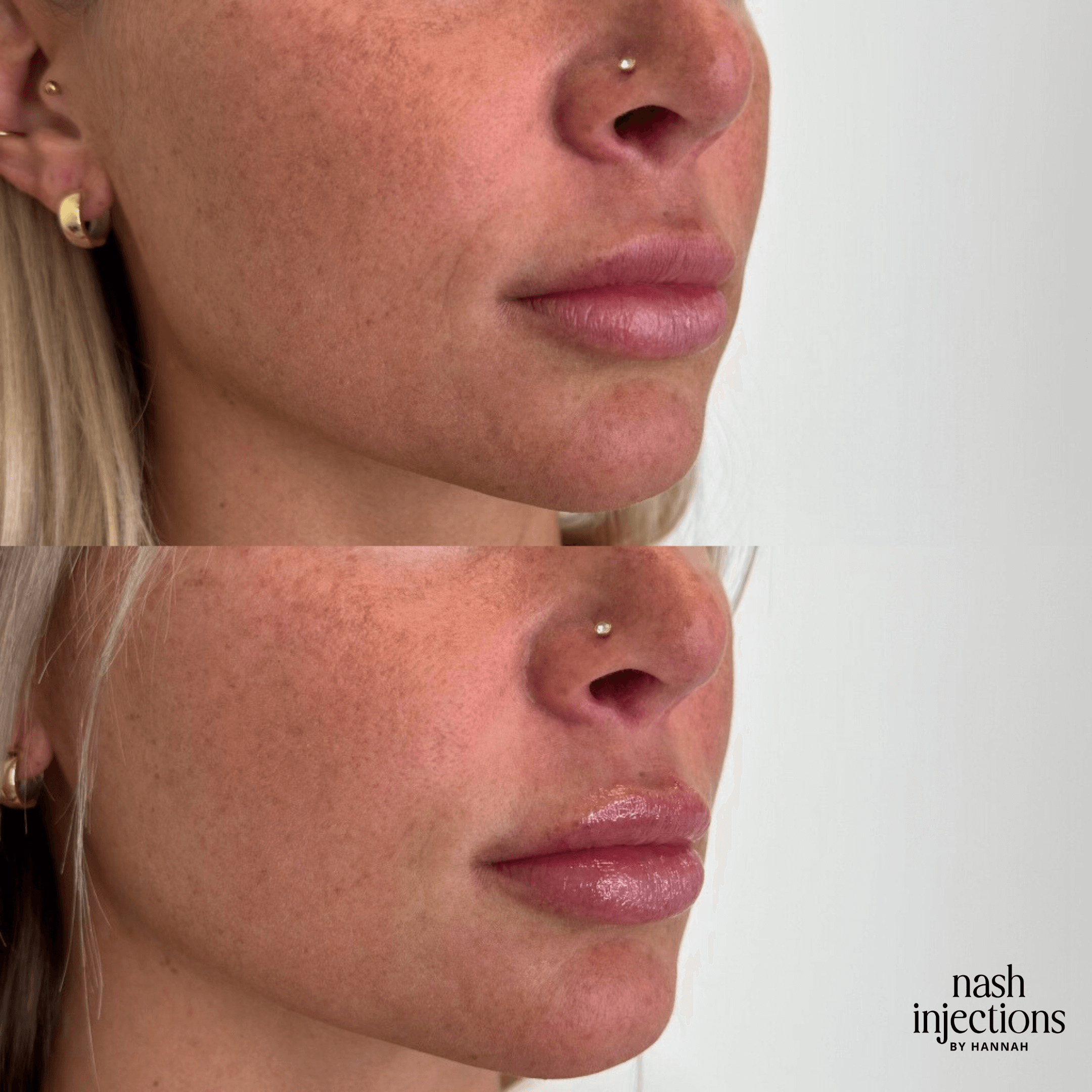 Side-by-side before and after comparison of lip augmentation on a woman's face, showing fuller lips in the after image.