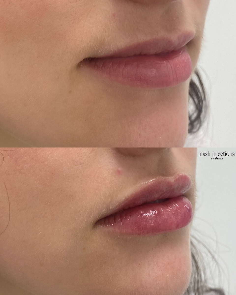 before + after pics (960 x 1200 px) (3).png