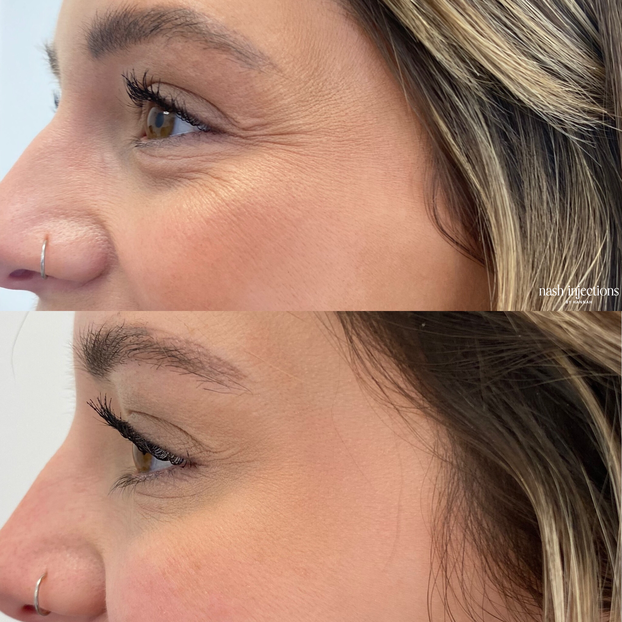 Before and After Botox