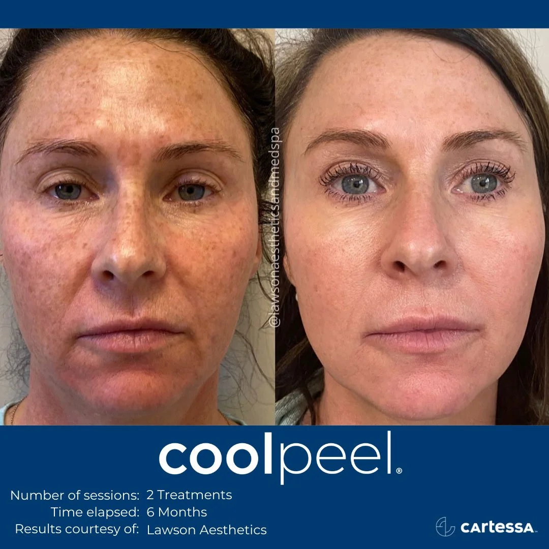 before and after coolpeel laser