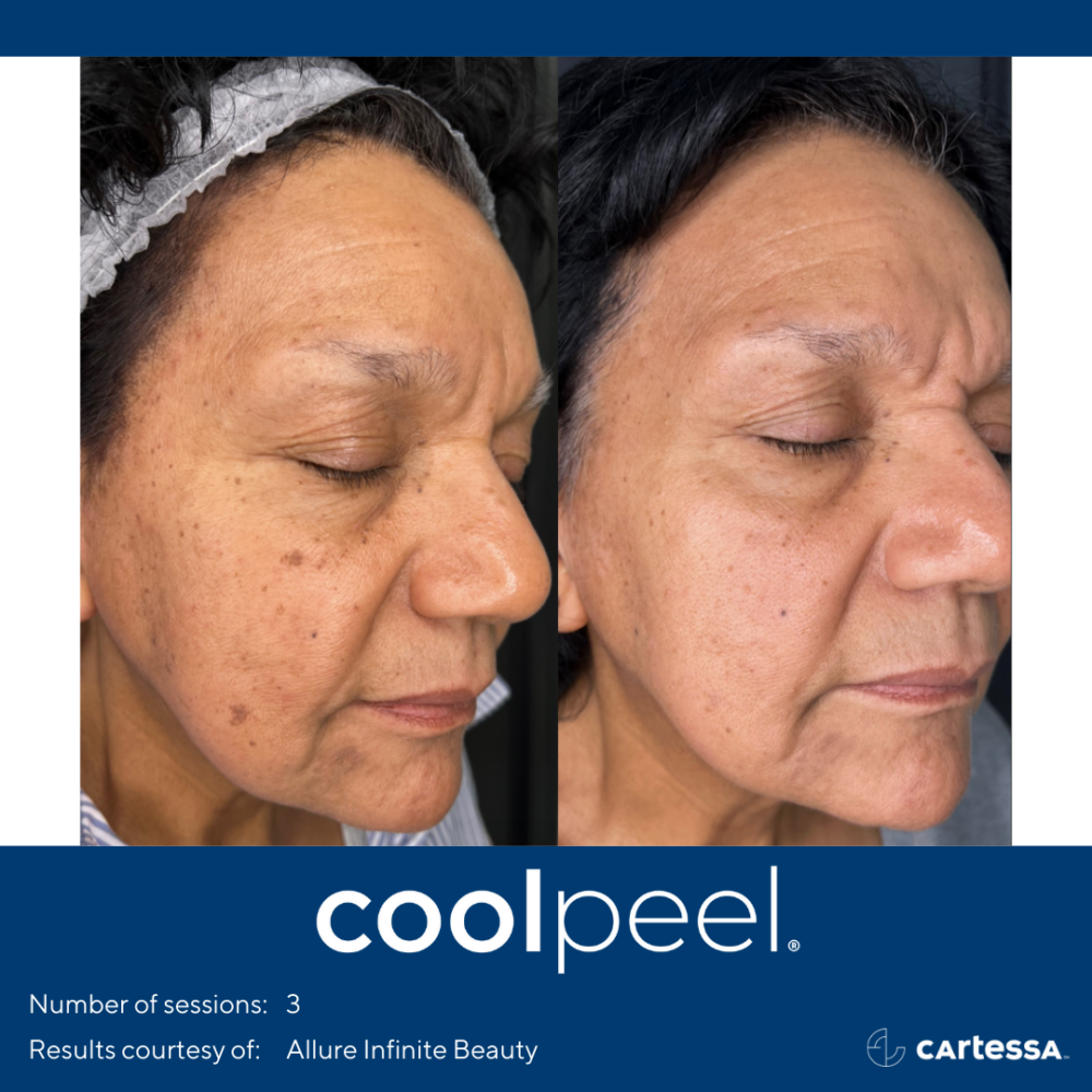 Before and After CoolPeel Laser Resurfacing