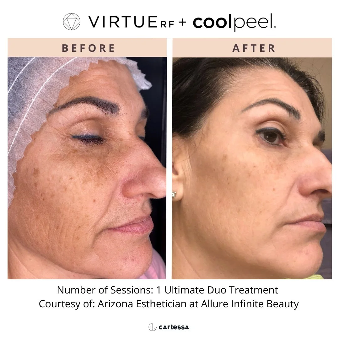 Before and after coolpeel laser and virtue rf