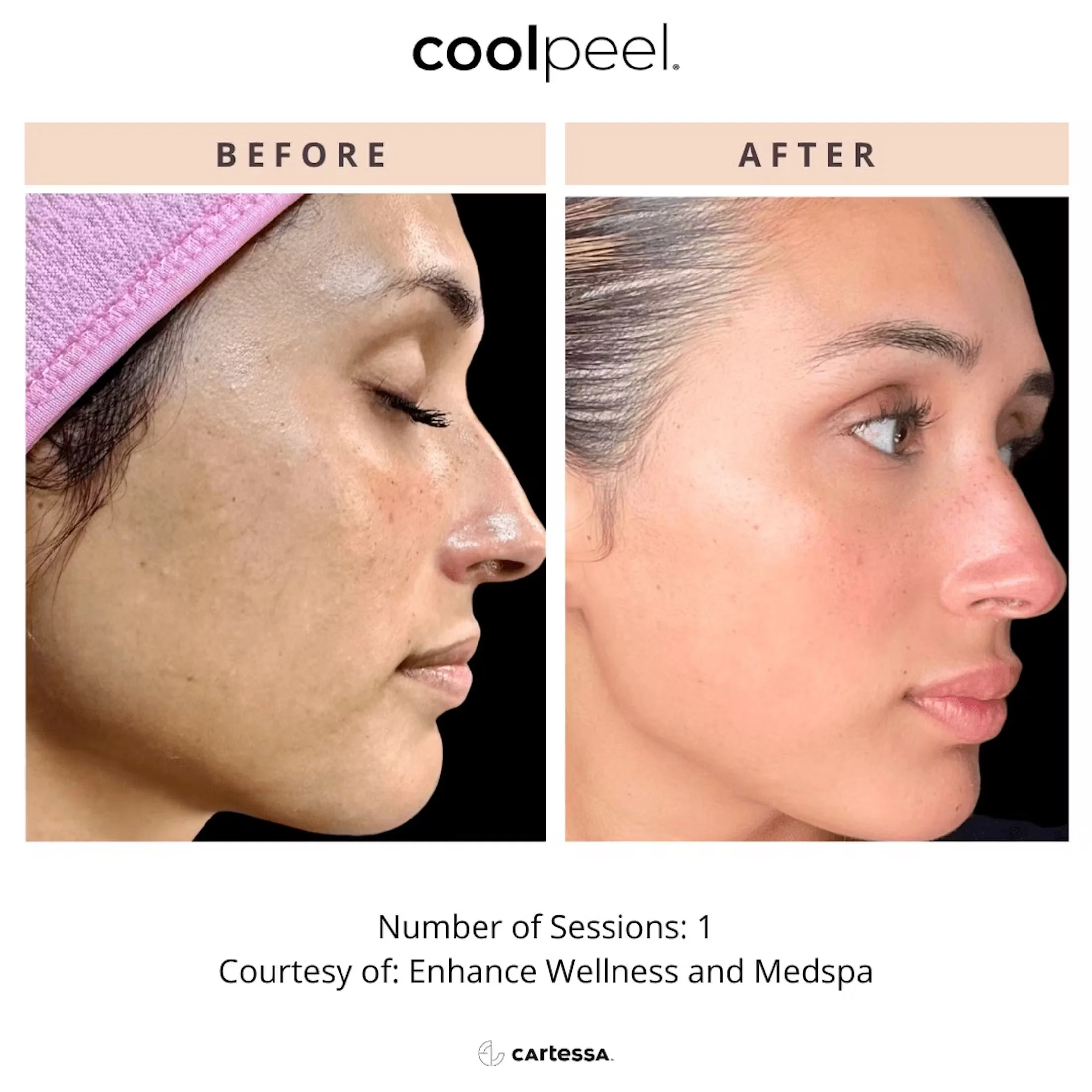 Before and After CoolPeel