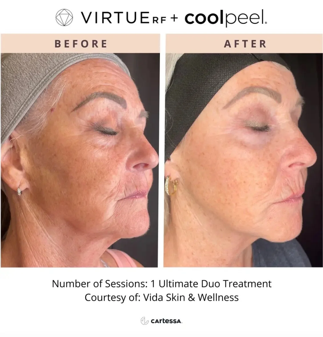 RF Microneedling and Laser Resurfacing