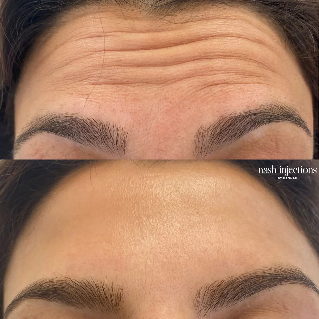Before and after forehead botox
