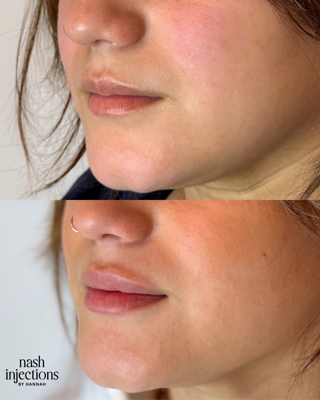 Lip filler before and after