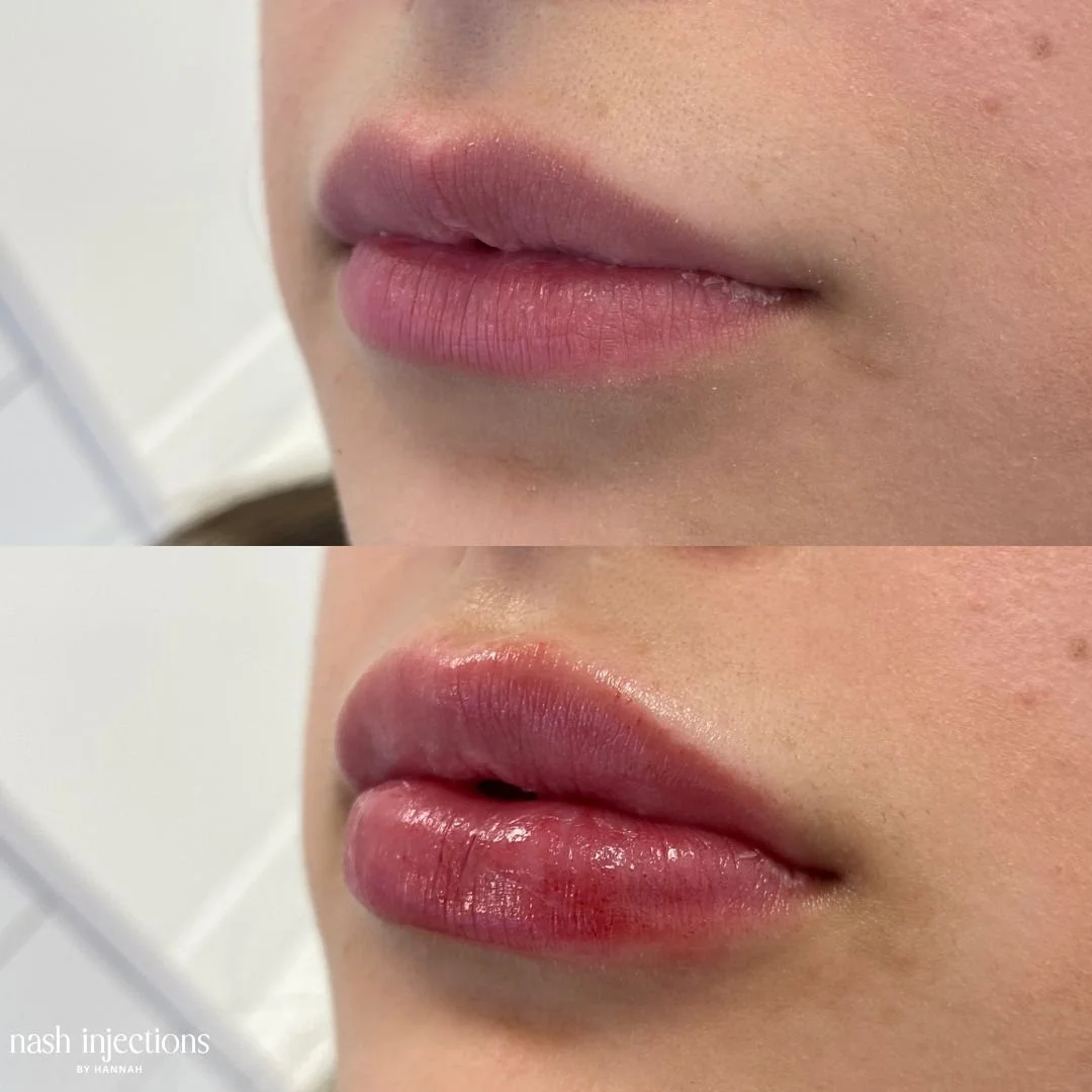 Before and after lip filler