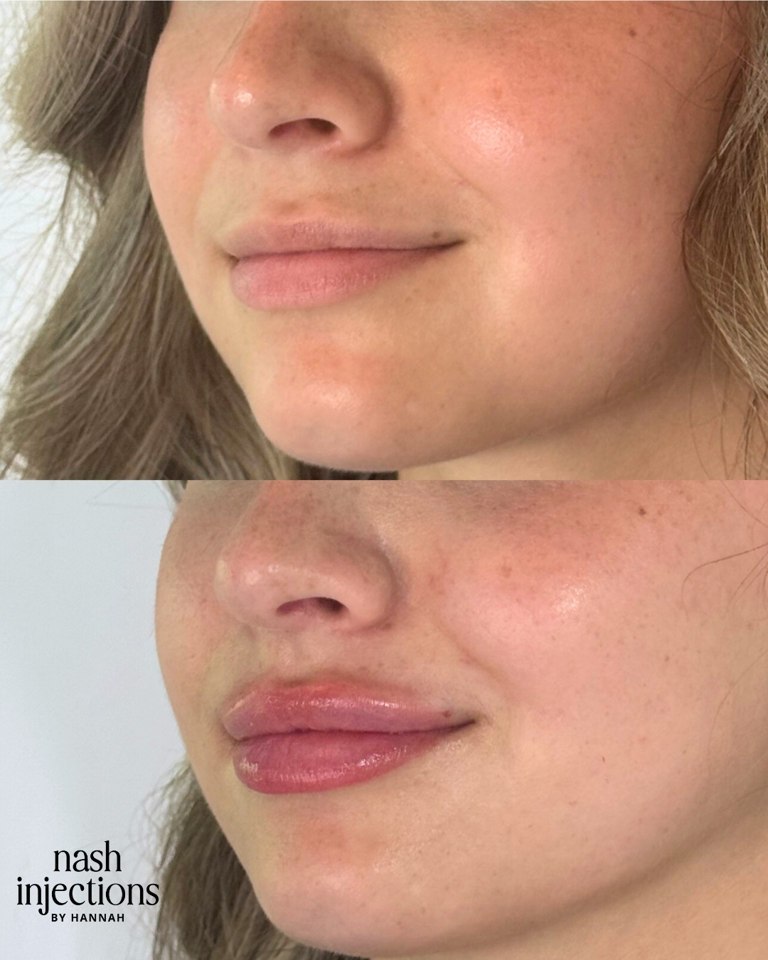 before and after lip filler