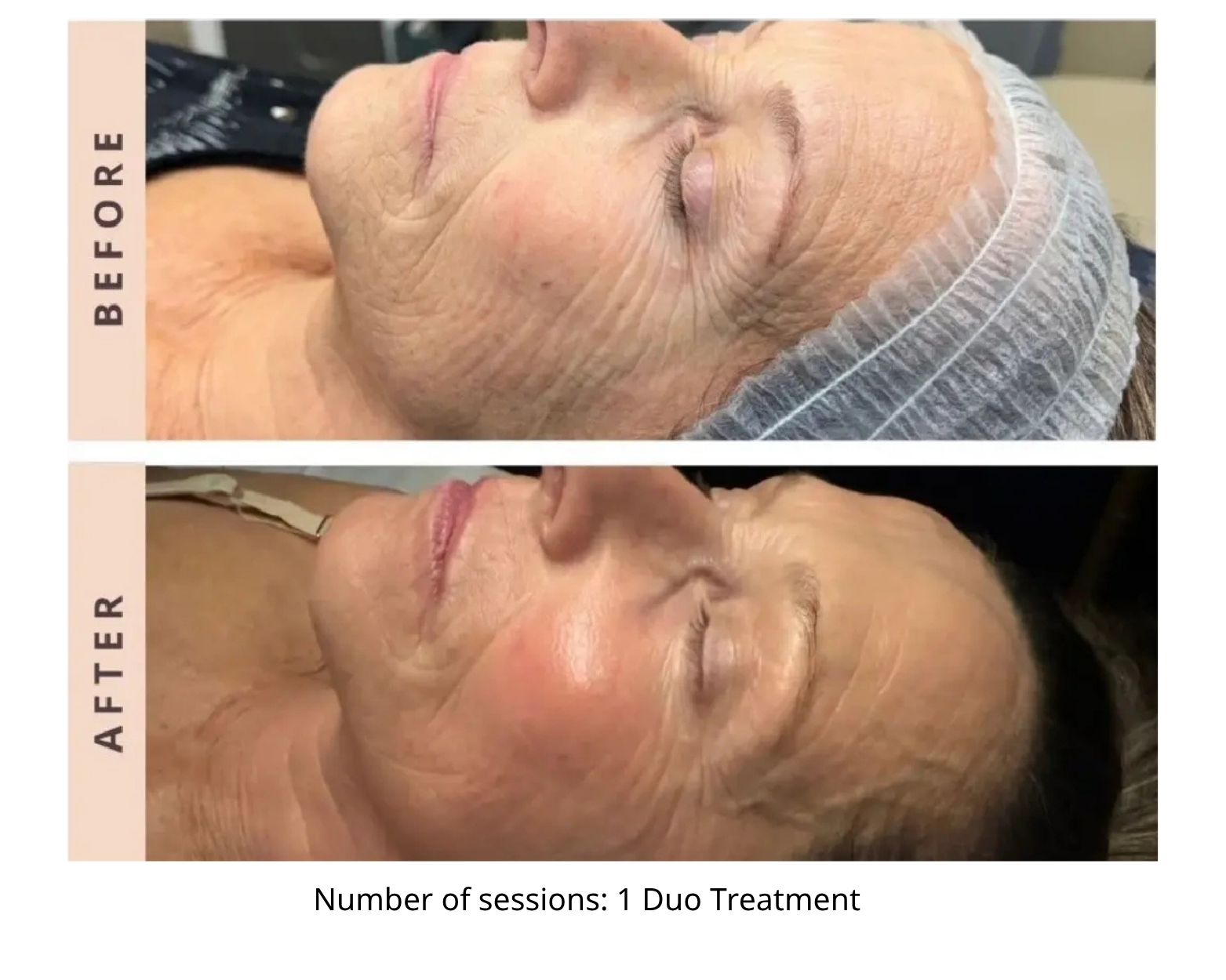 Before and After RF Microneedling and CoolPeel