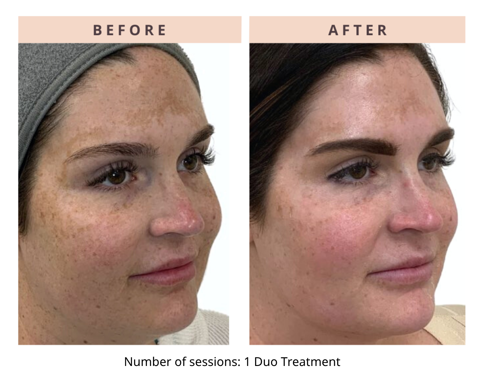 Before and After CoolPeel and RF Microneedling