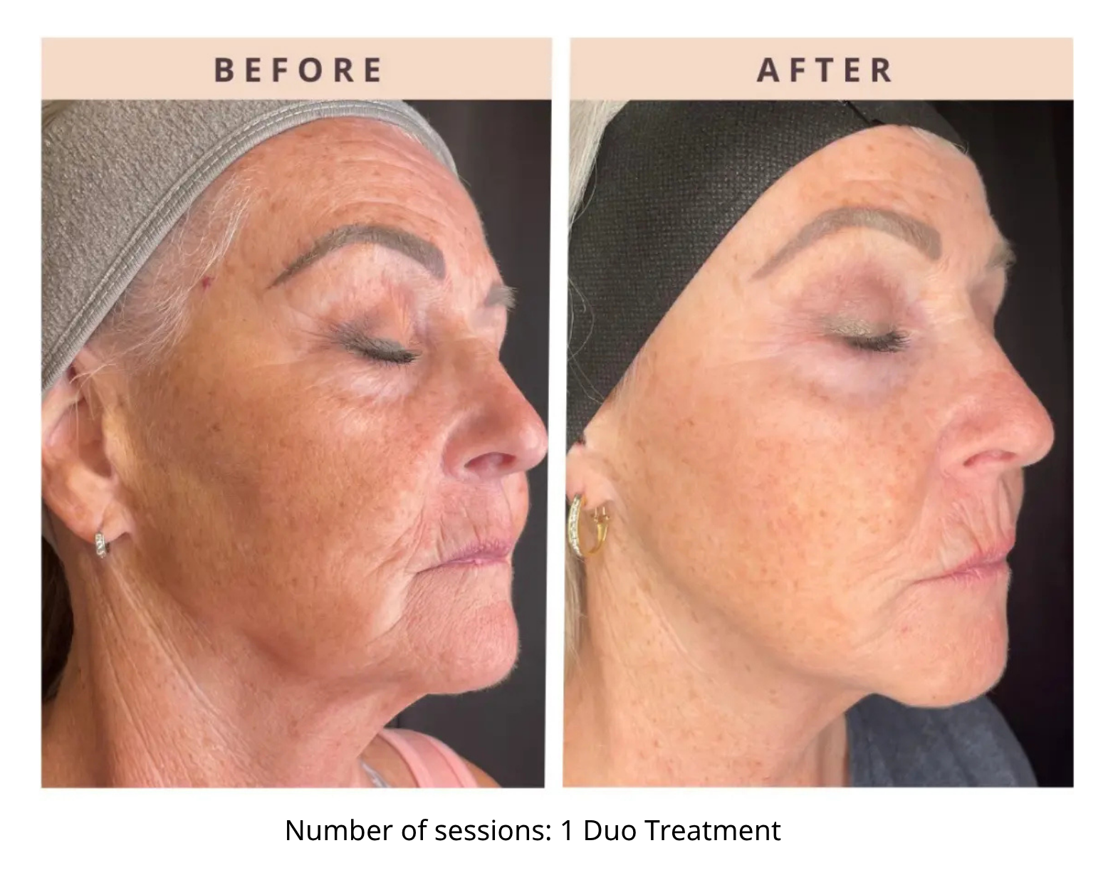 Before and After RF Microneedling and Laser Skin Resurfacing